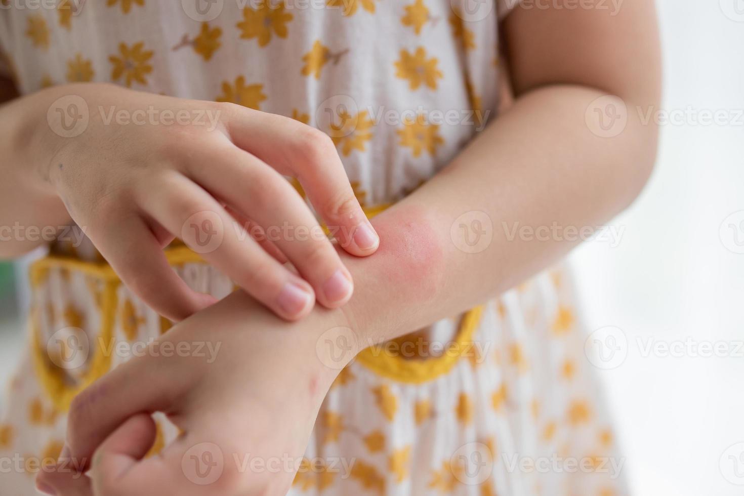 Little girl has skin rash allergy itching and scratching on her arm photo