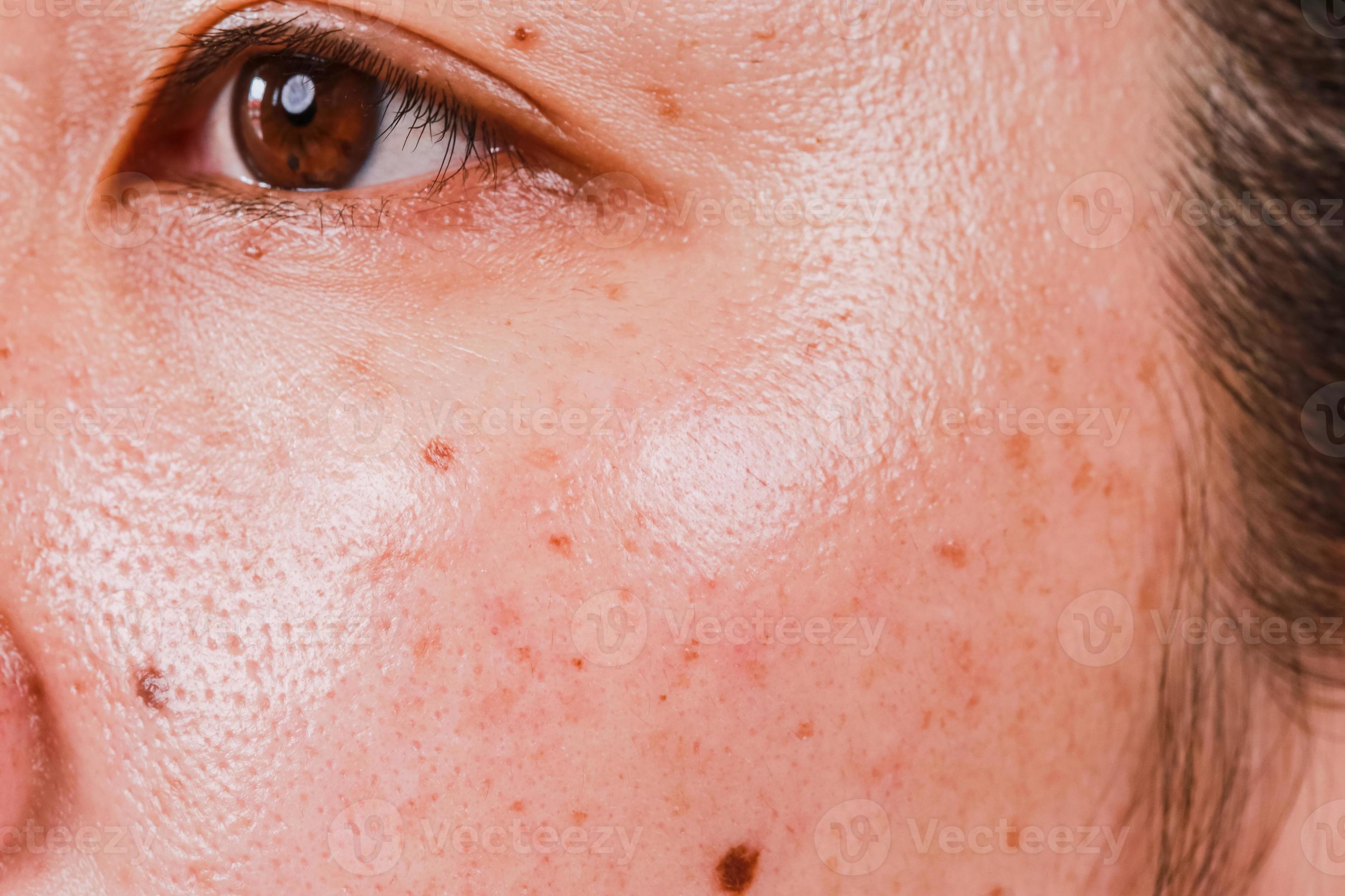 Skin Care Problems And Health Concepts Wrinkles Pores Freckles Dark 