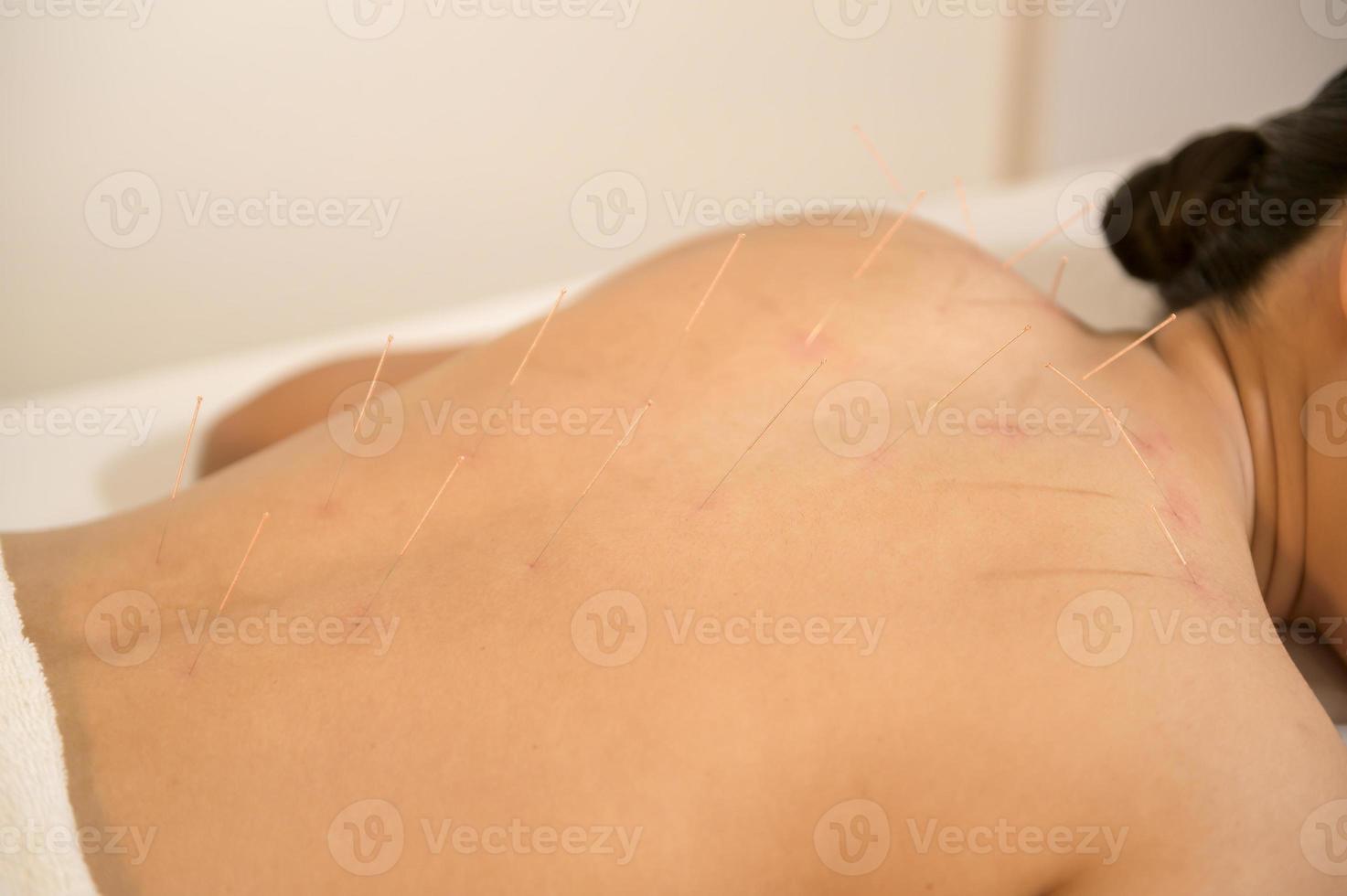Beautiful Woman Received acupuncture treatment on back by  therapist, chinese medicine treatment, health and healing concept. photo