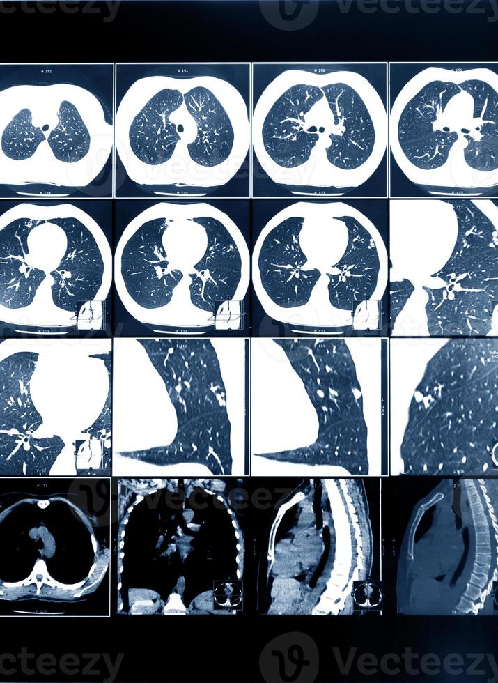 Magnetic resonance therapy of human lungs. Prevention of various diseases. photo