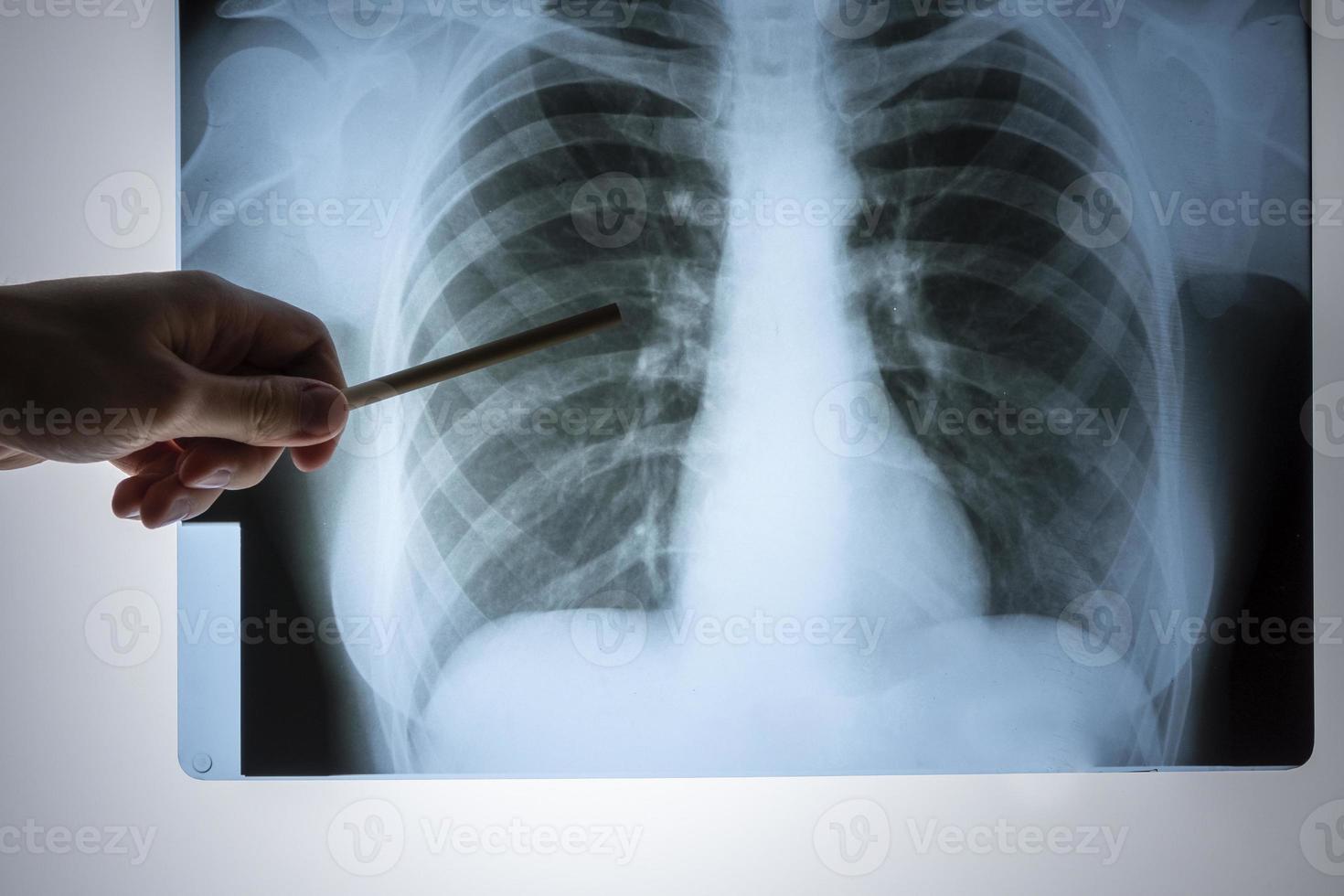 X-ray of the lungs. Chest x-ray. Doctor's view of the lung image in the hospital on a reflective board, blurred focus photo