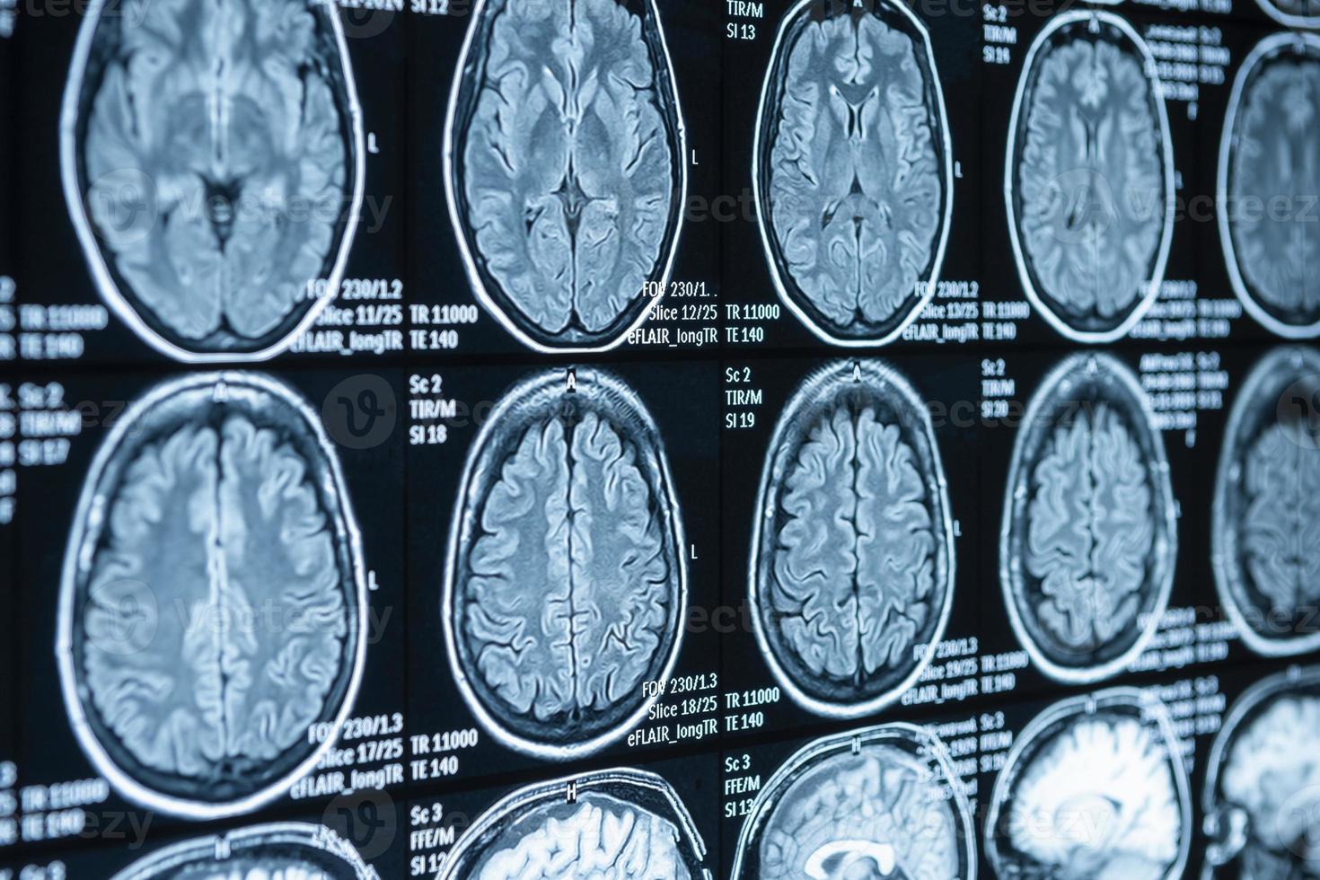 resonancia magnética, tomografía computarizada de la columna vertebral. comprobando las secciones traseras en el hospital. foto