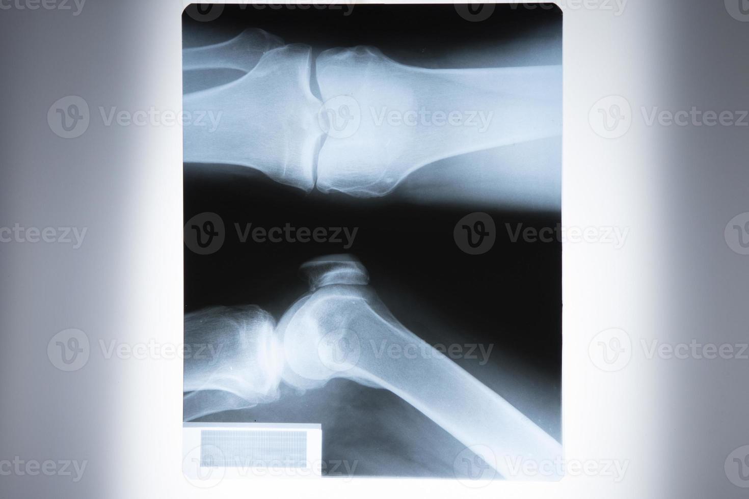 A close-up X-ray of a patient with a knee injury in a hospital on a reflective board, blurred focus photo