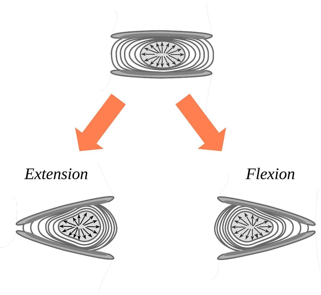 deformación del disco intervertebral debido al movimiento de flexión y extensión vector