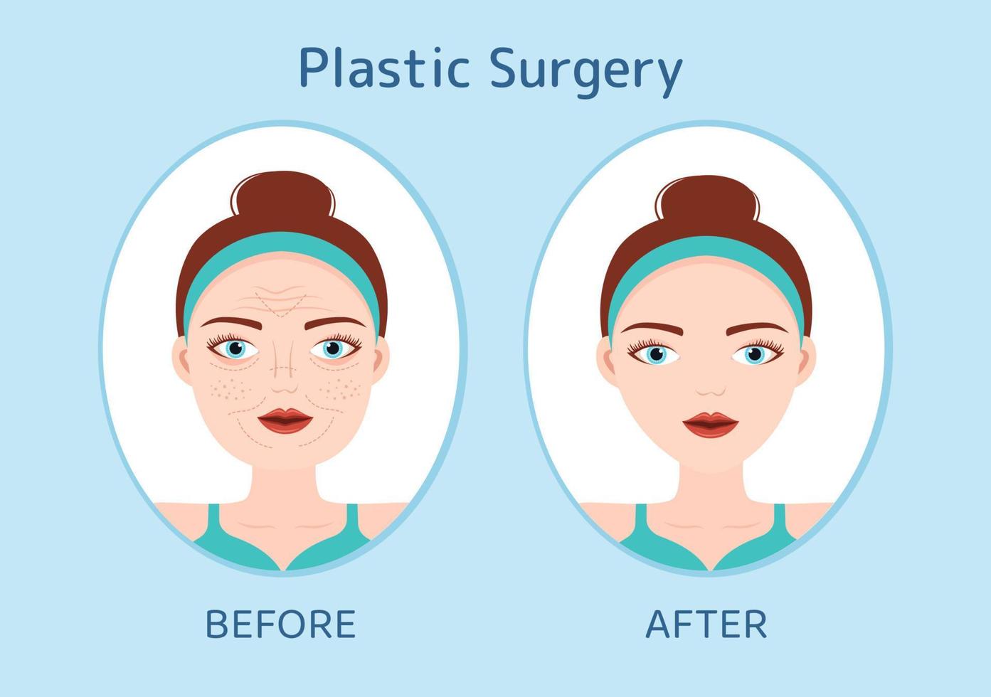 Plastic Surgery Flat Cartoon Hand Drawn Templates Illustration of Medical Surgical Operation on the Body or Face as Expected using Advanced Equipment vector