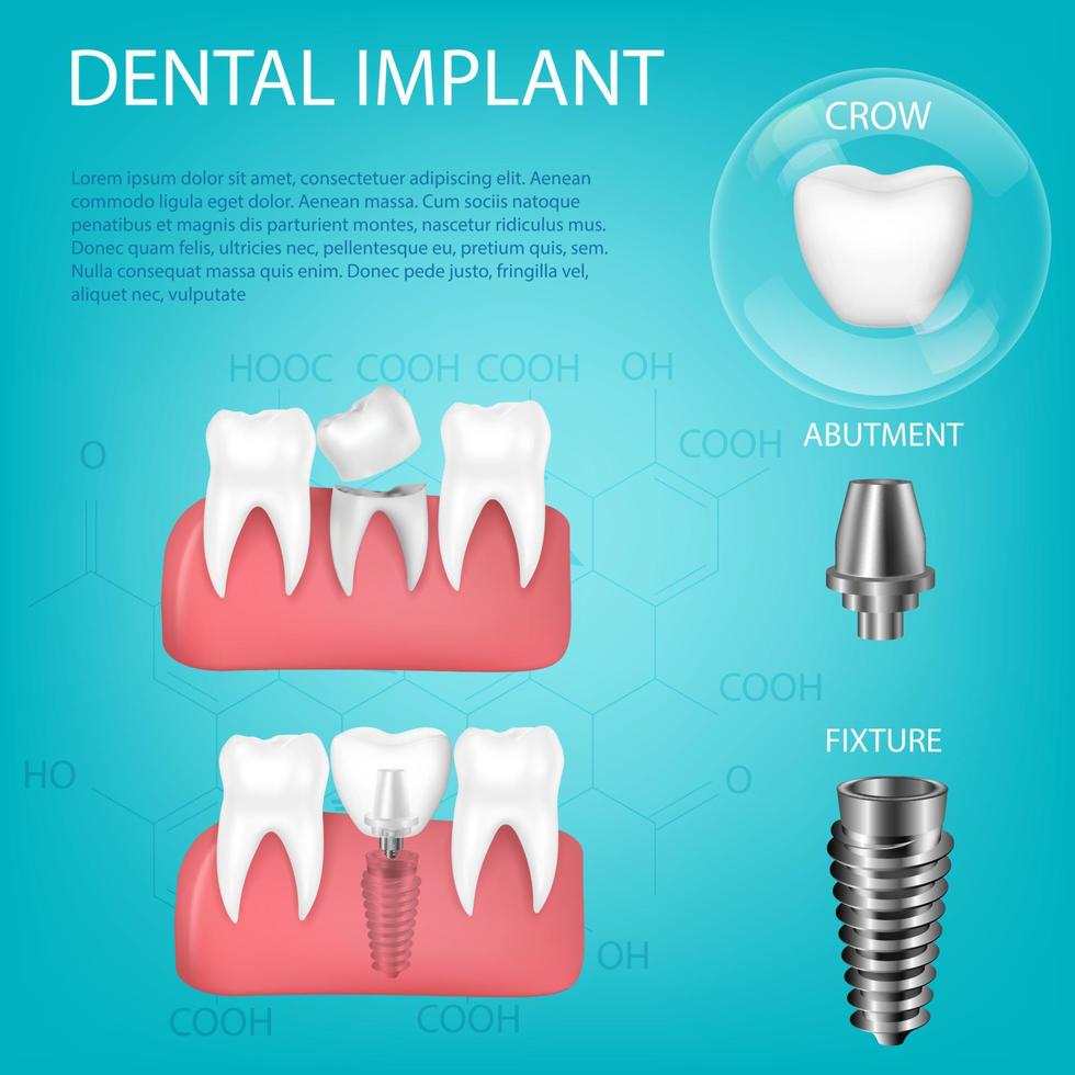 Vector realistic, 3D set of dental implants with installation in the gum. Structural elements of dental implant isolated with text.