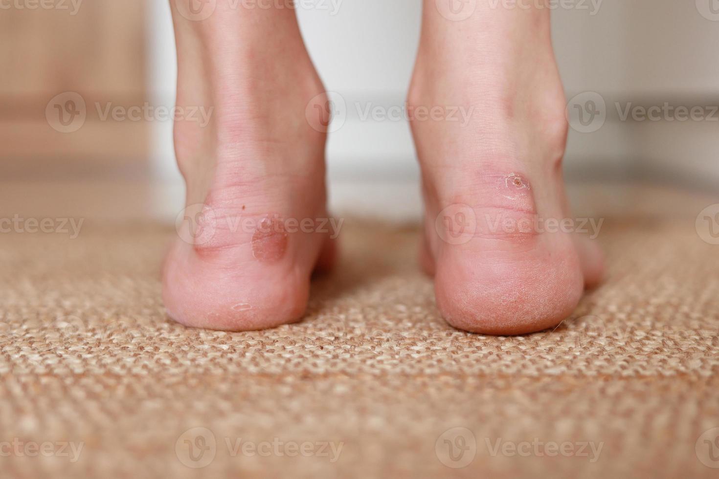 Callus blisters on woman feet. Painful wounds. shoes problems. View of foot with