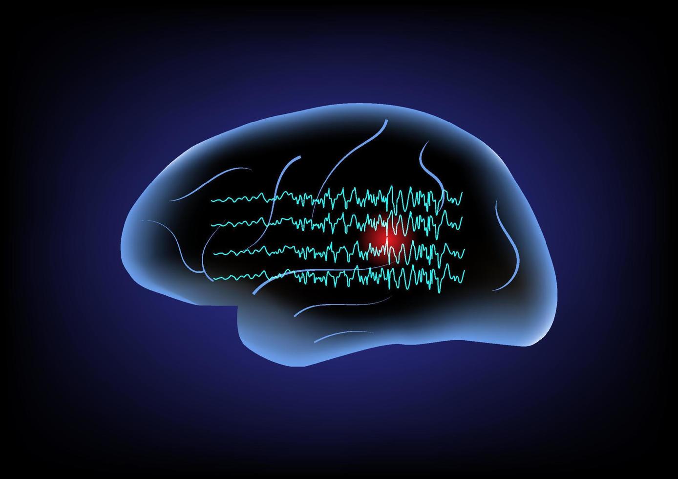 Abnormal brain waves and human brain. Concept of focal seizure. vector