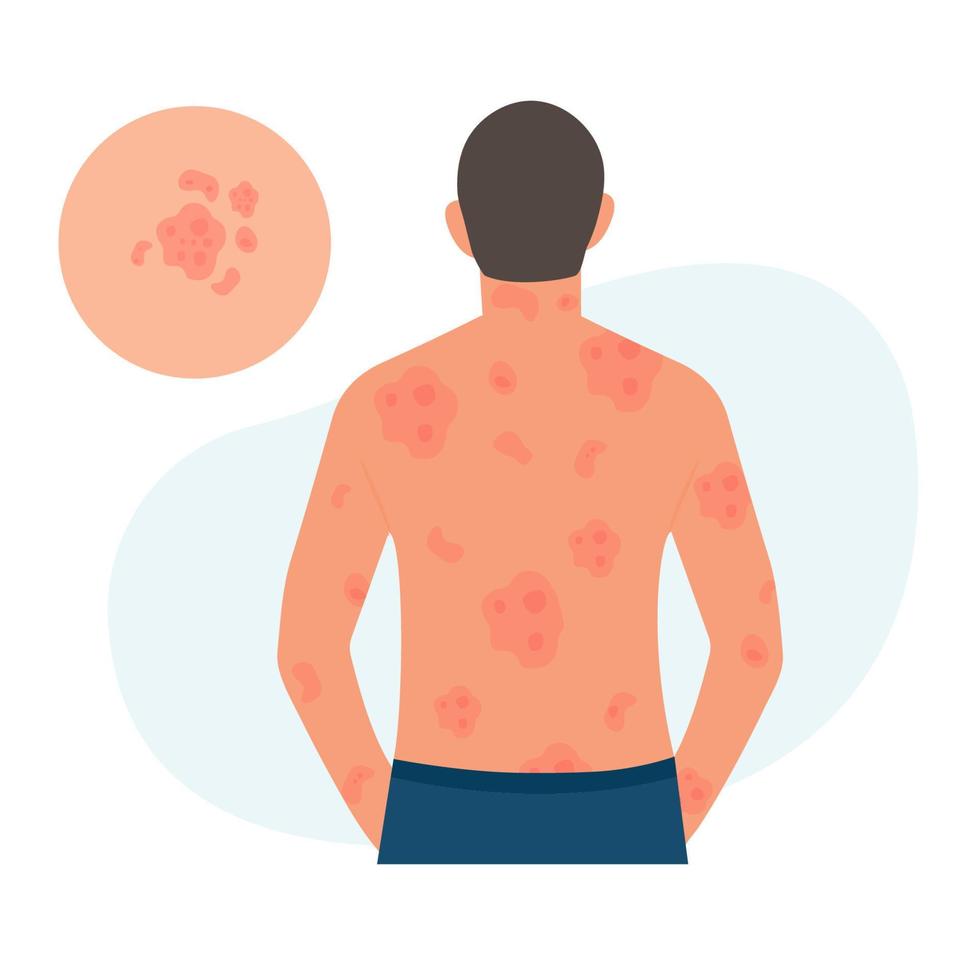 The man has alergic itching, skin inflammation, redness and irritation.Guttate psoriasis.Atopic dermatitis, eczema, psoriasis, dry skin. Skin problems.isolated, vector. vector