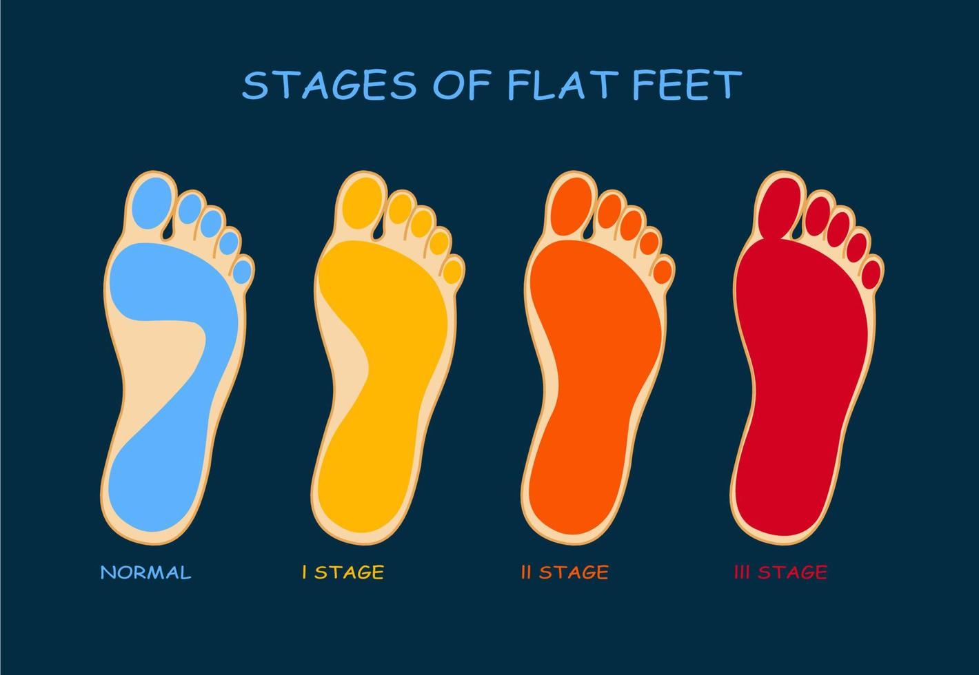 etapas de los pies planos vector