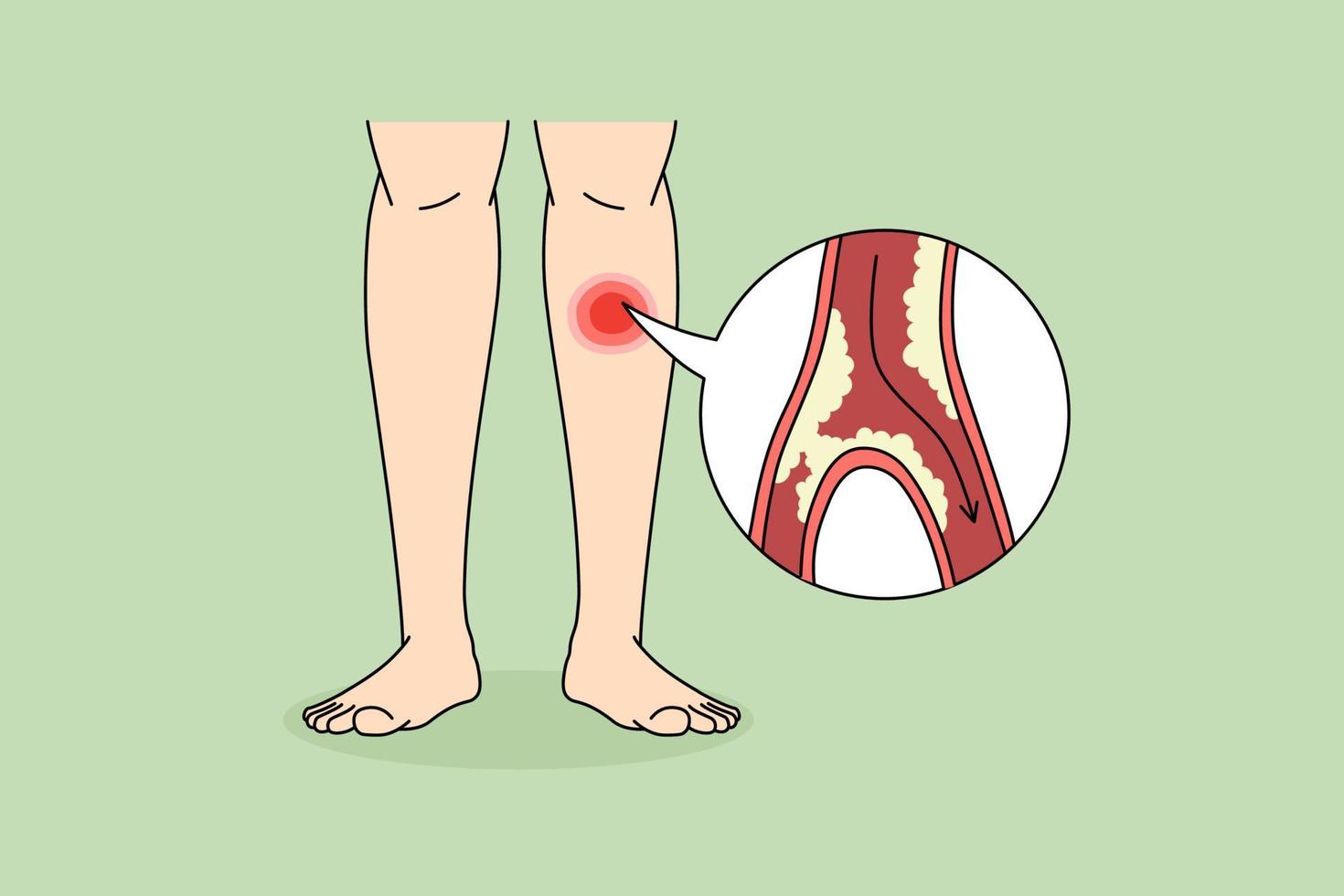 Close up of person suffer from PAD disease having blood vessel blockage in legs. Man struggle with clotted limbs from veins narrowing or blocking. Healthcare concept. Vector illustration.