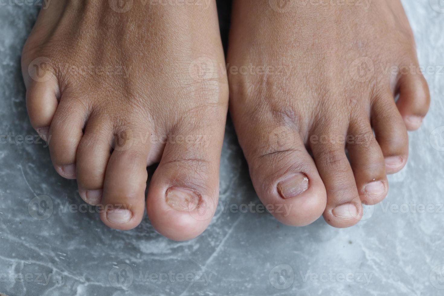 Broken nails leg photo