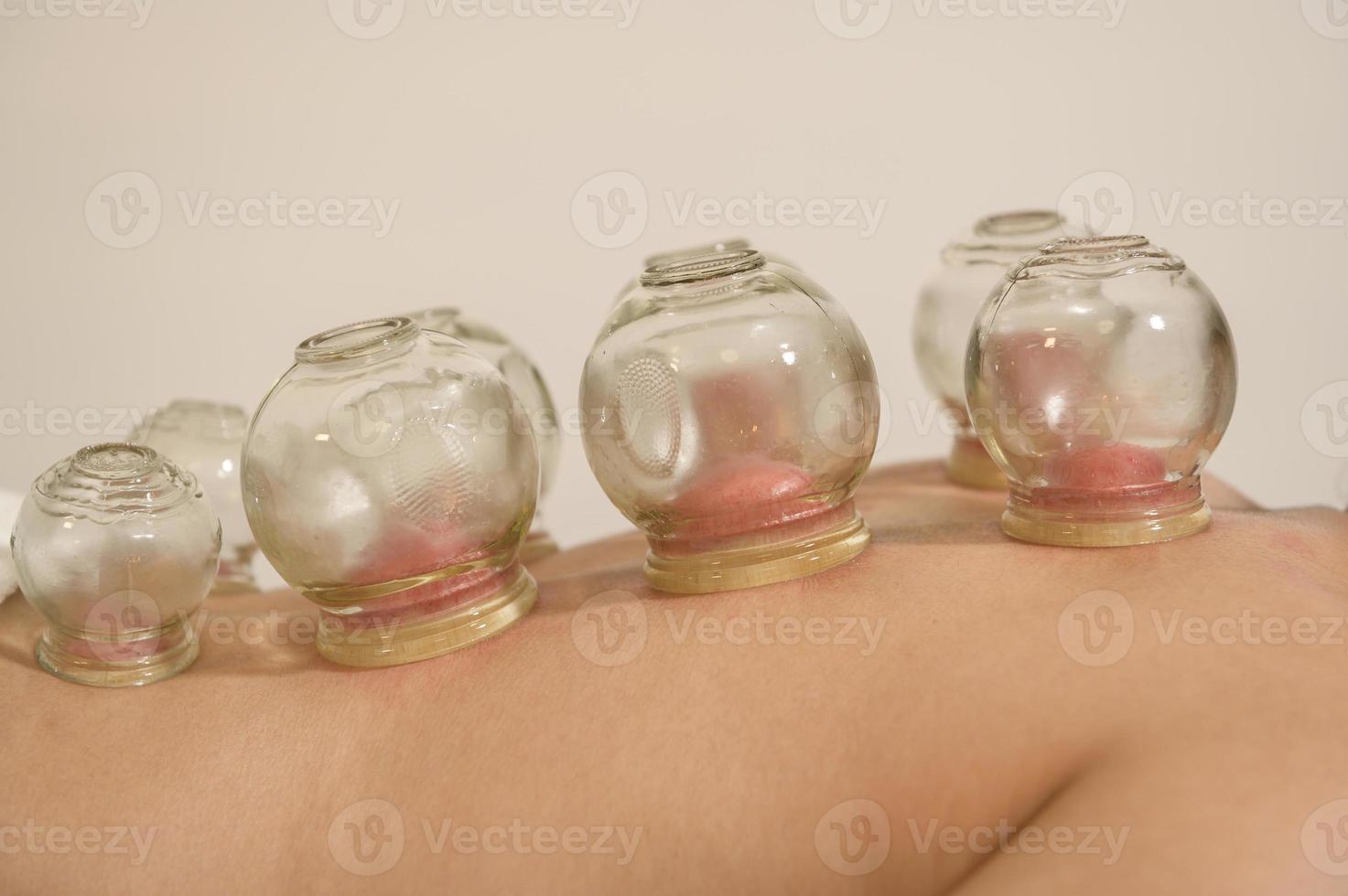 Beautiful Woman Received cupping treatment on back by  therapist, chinese medicine treatment, health and healing concept. photo
