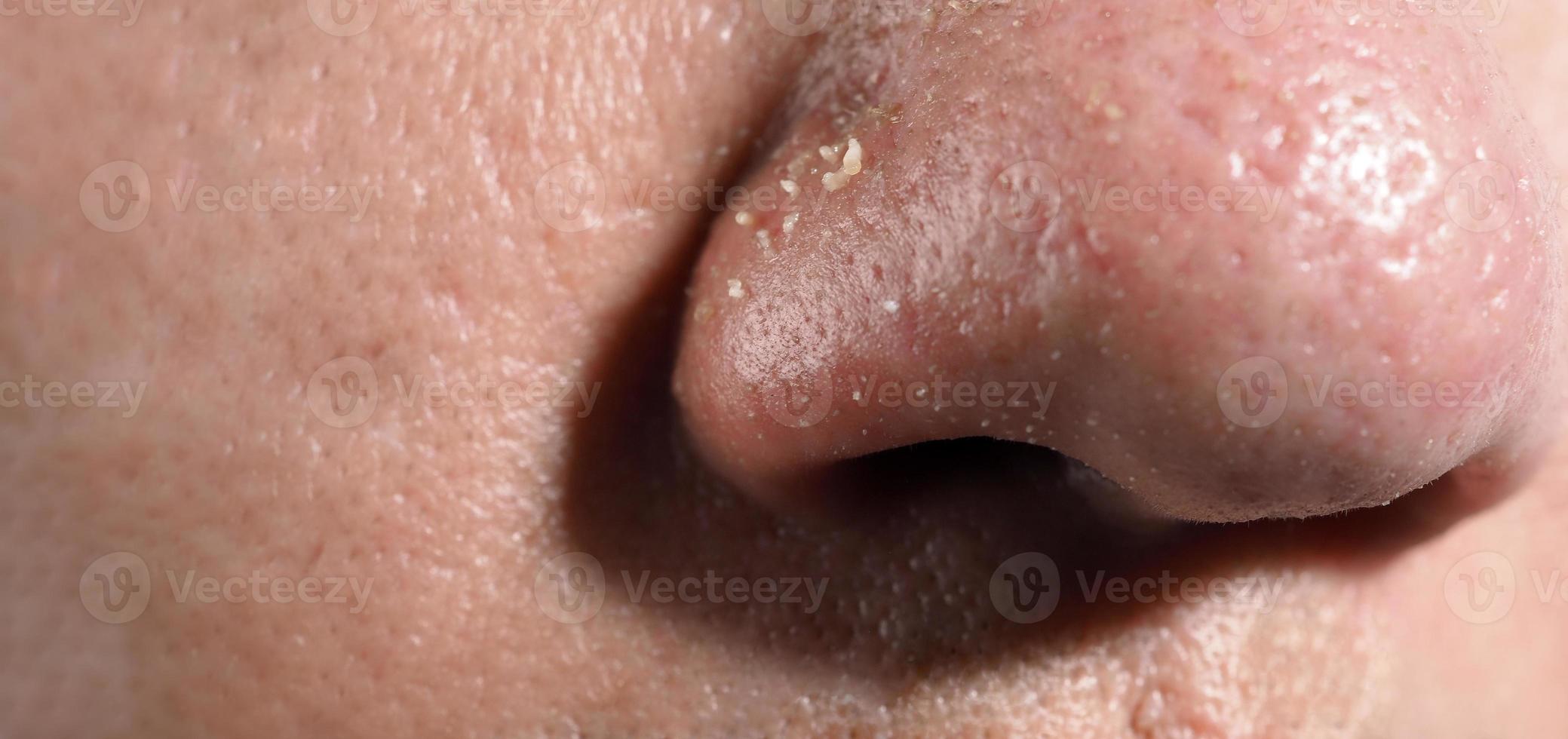 Acne and problem pores. White and blackhead pimples from nose pores. photo