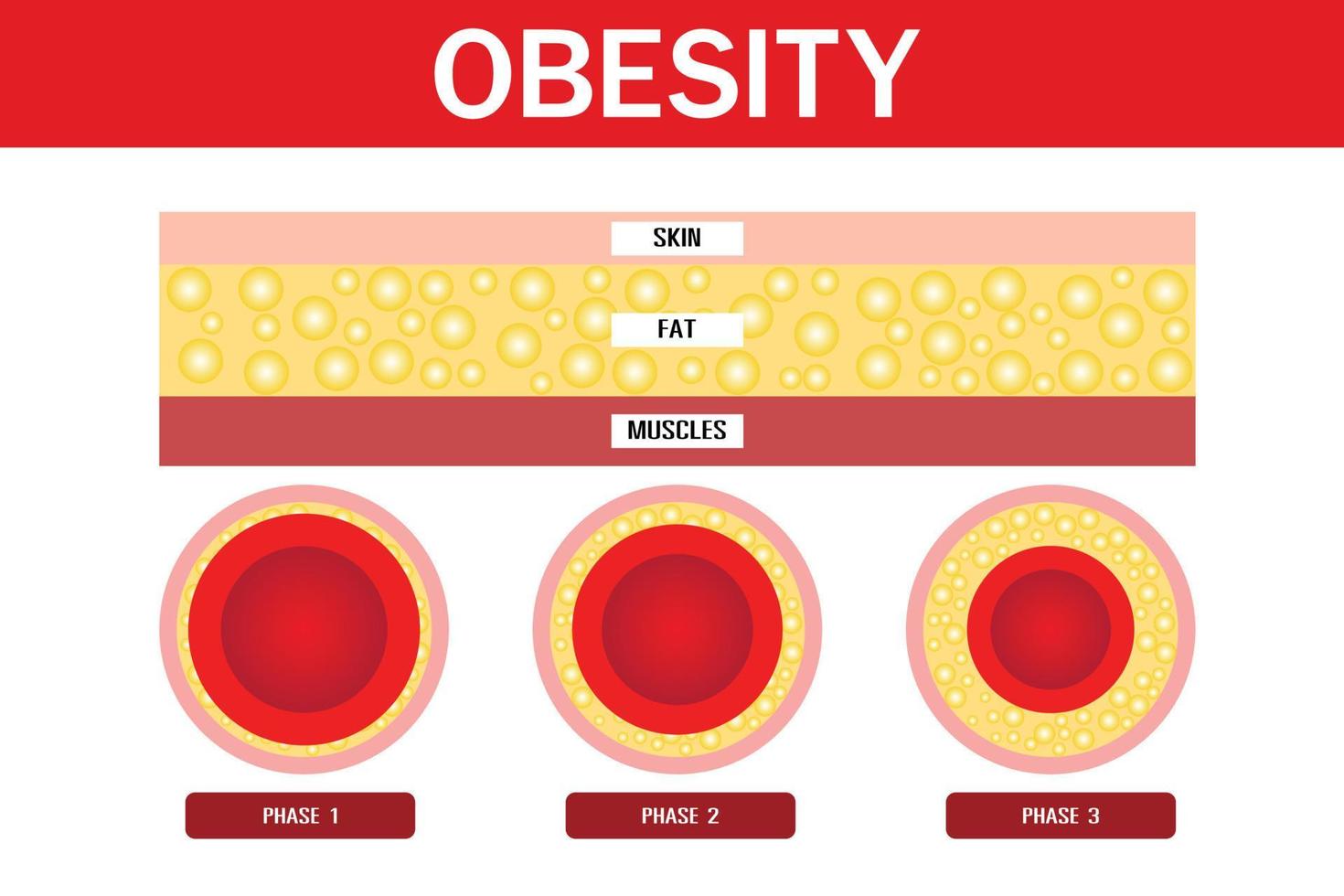 obesidad y sobrepeso, capas de piel, diseño vectorial vector