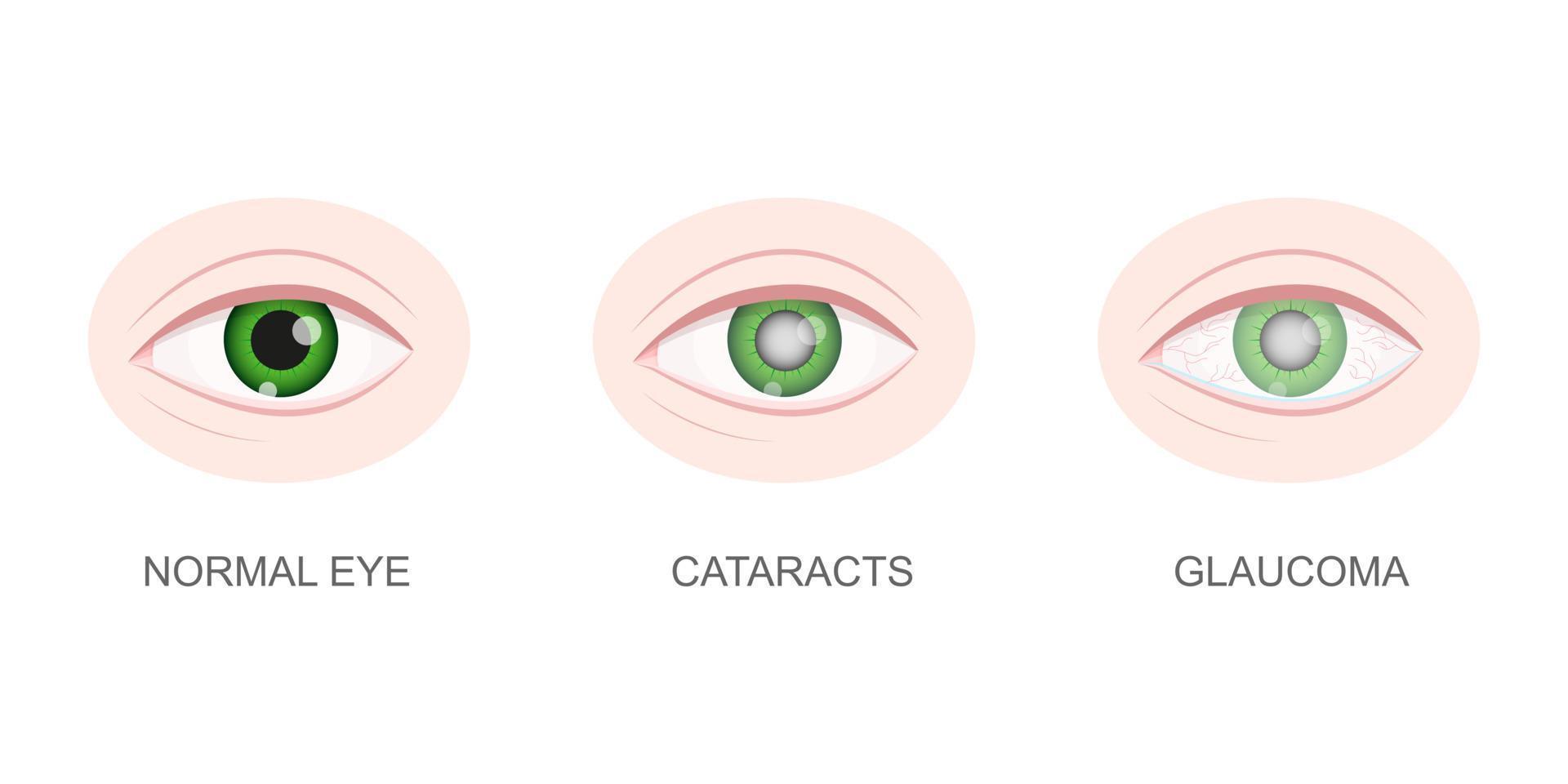 vista de primer plano del ojo sano, con cataratas y glaucoma. globo ocular con lente normal y no saludable. concepto de problemas visuales de envejecimiento. órgano humano anatómicamente detallado de la visión vector