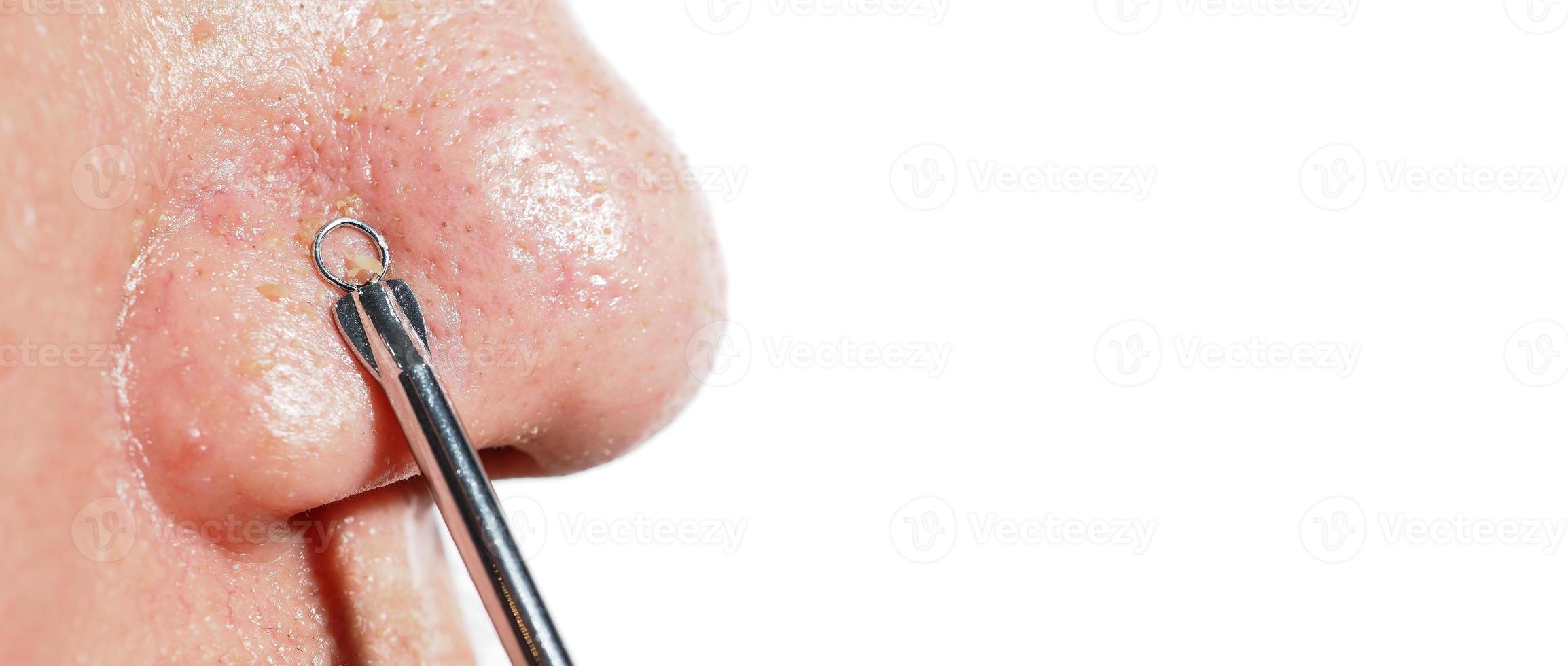 Acne and problem pores. White and blackhead pimples from nose pores. photo