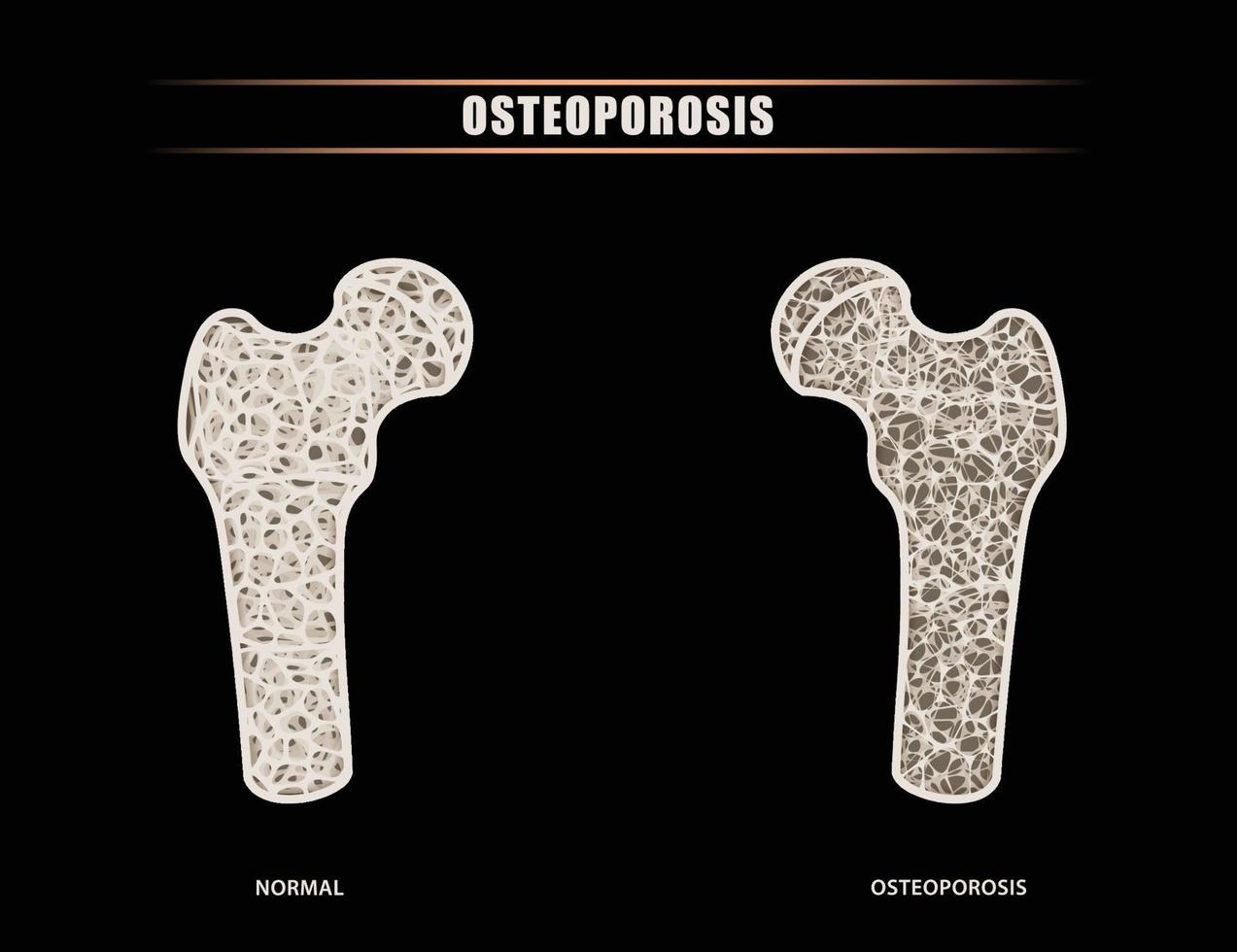 Illustration of a human femur versus hip intra-articular comparison of normal bone symptoms with osteoporosis. vector