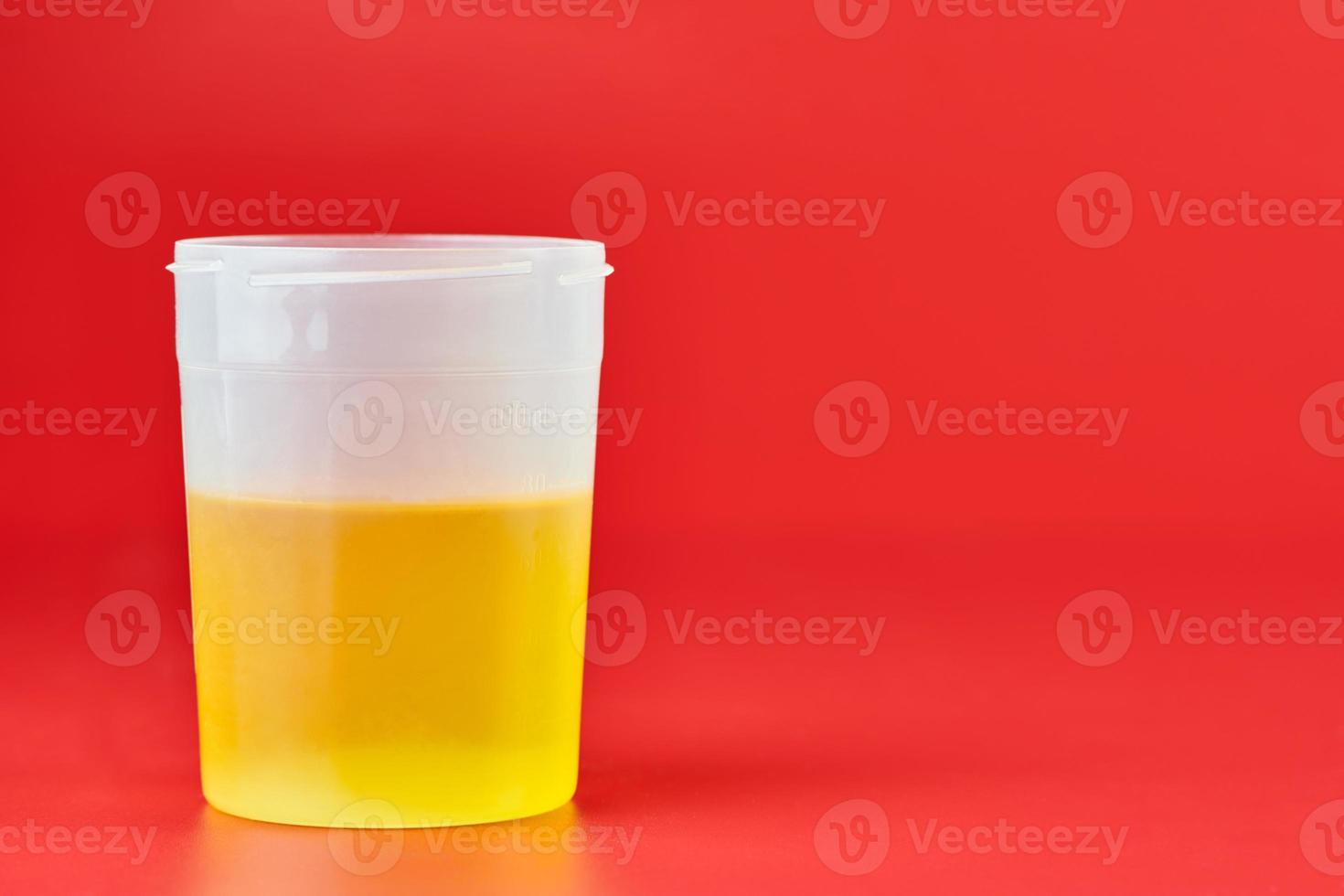 Urinalysis for urolithiasis in container photo