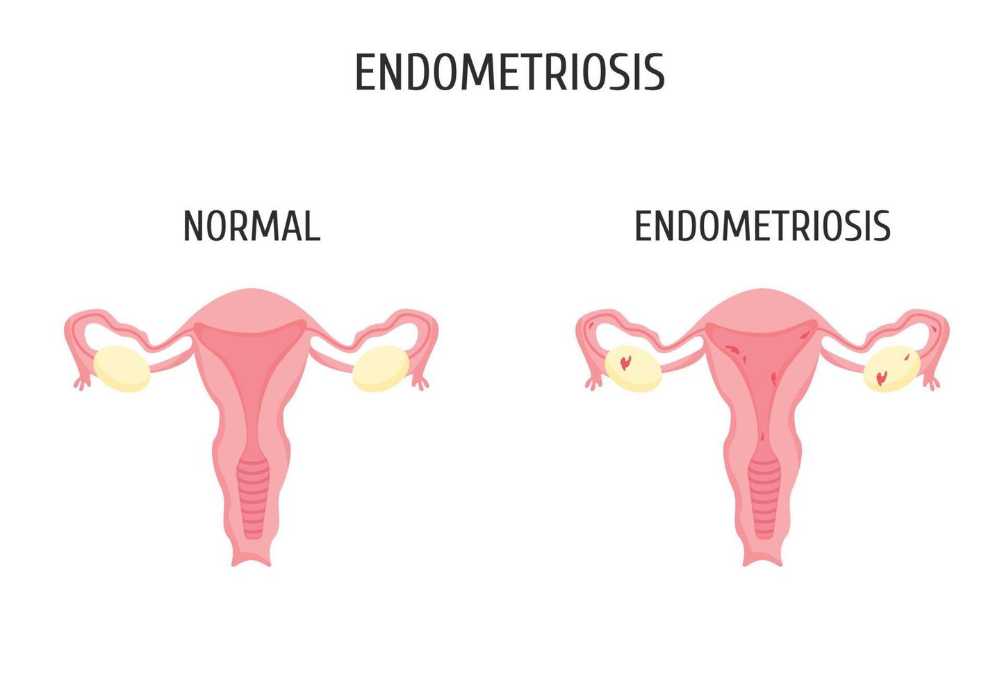 Female genital organs with and without endometriosis. Infographics. vector