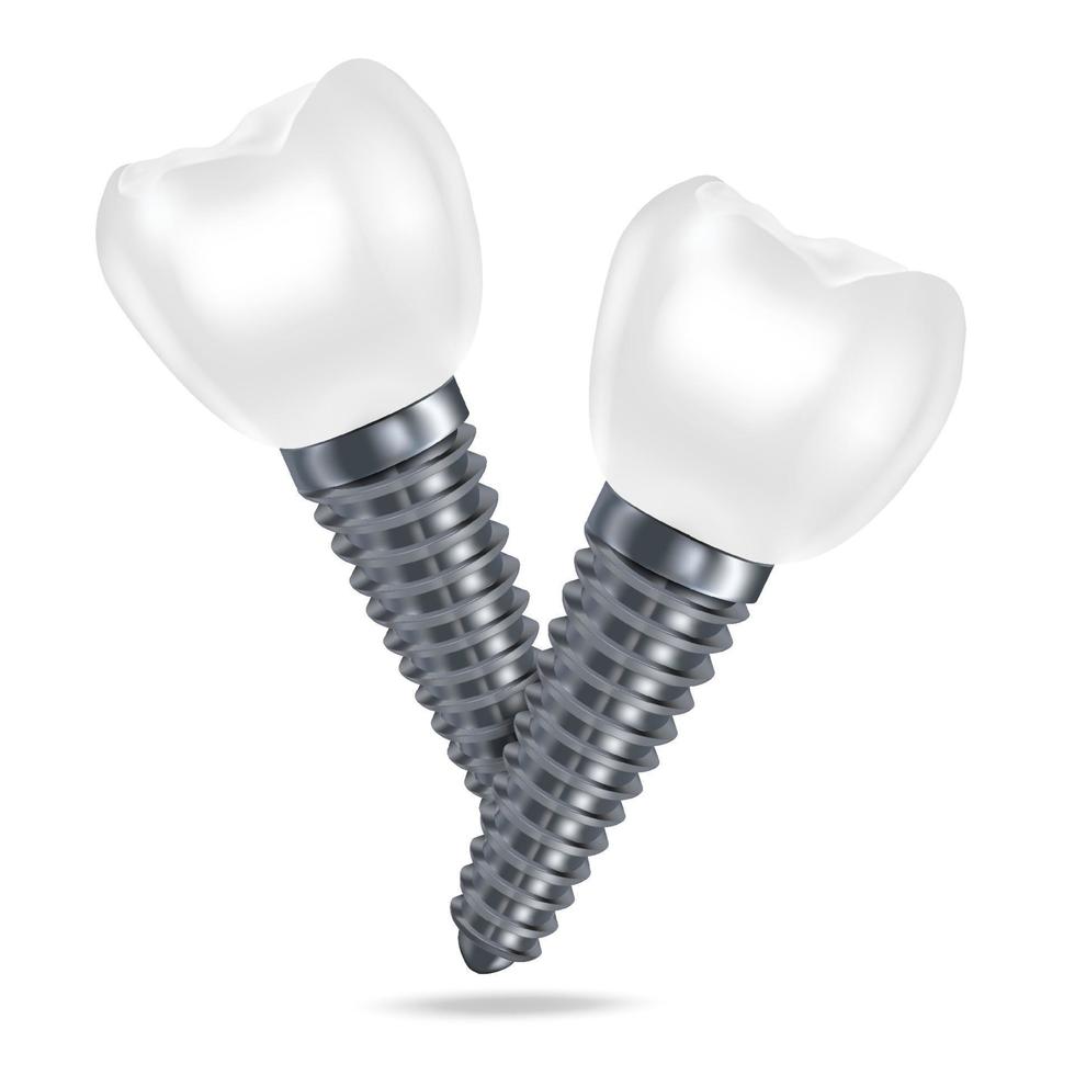 Vector 3d realistic rendering of white dental implant dentures closeup isolated on white background. Dentistry, medicine and healthcare concept. Prosthesis design template. Foreground.