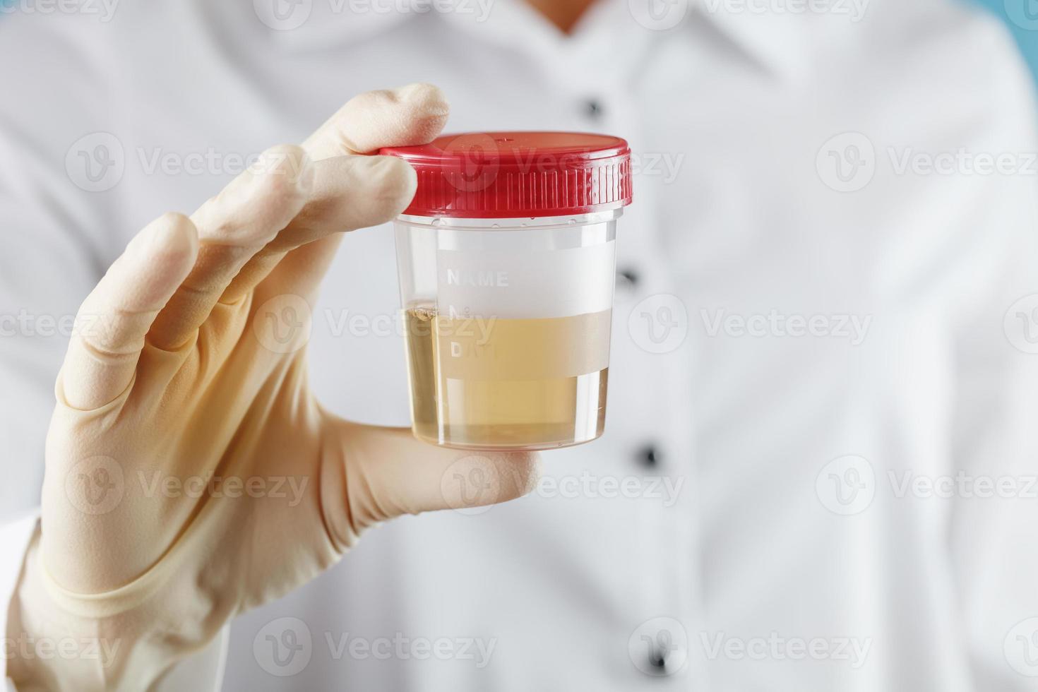 A doctor in a white coat holds a plastic container with yellow urine in his hand. photo