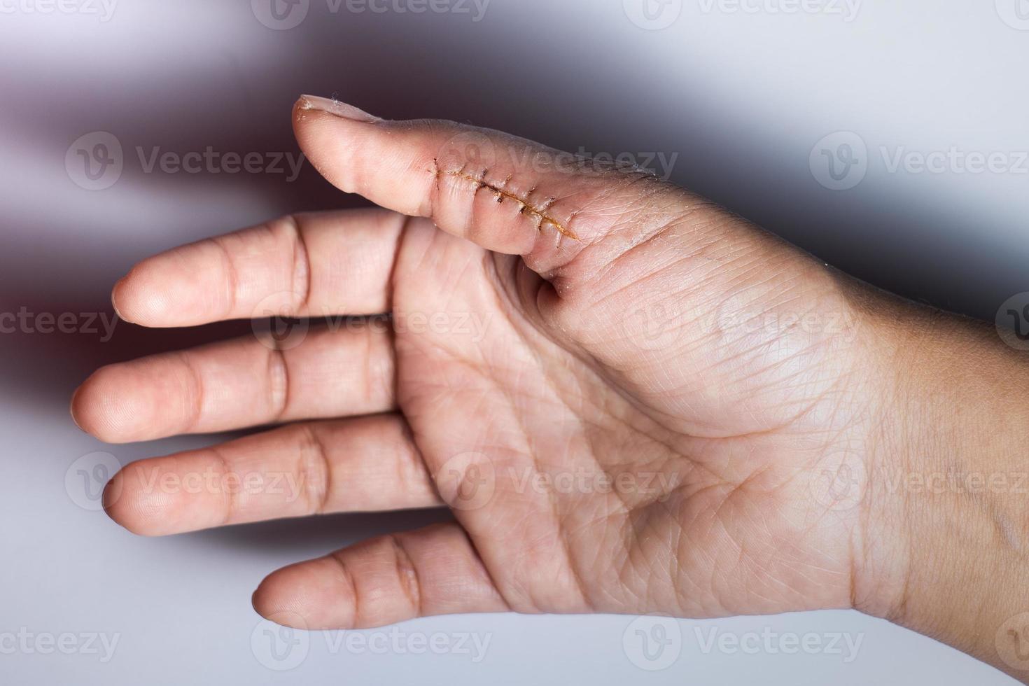 primer plano de una mano herida con puntos, herida en el pulgar sobre fondo blanco. cicatriz, sutura, accidente foto