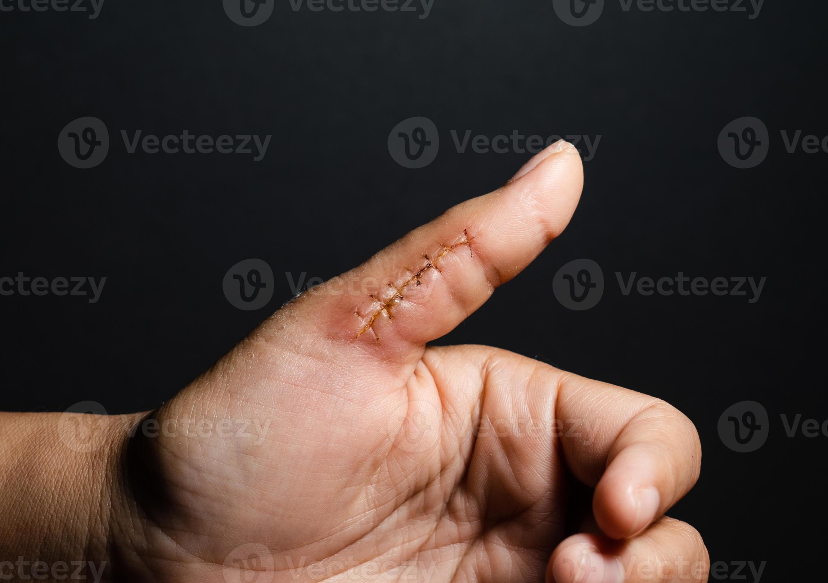 Closeup of a hand wound with stitches, thumb wound on black background