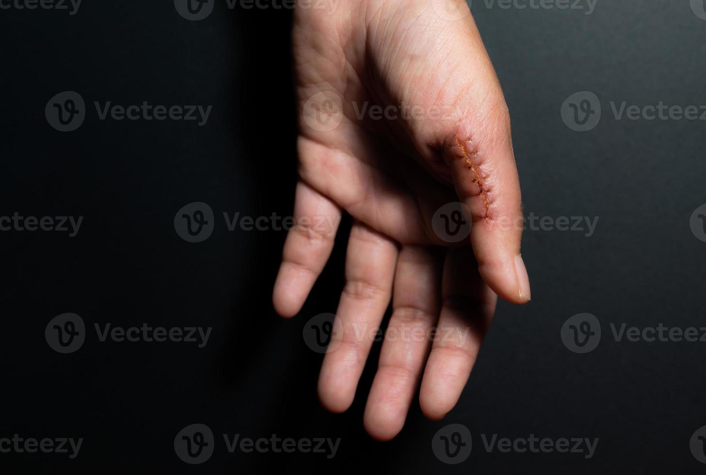 primer plano de una mano herida con puntos, herida en el pulgar sobre fondo negro. cicatriz, sutura, accidente foto