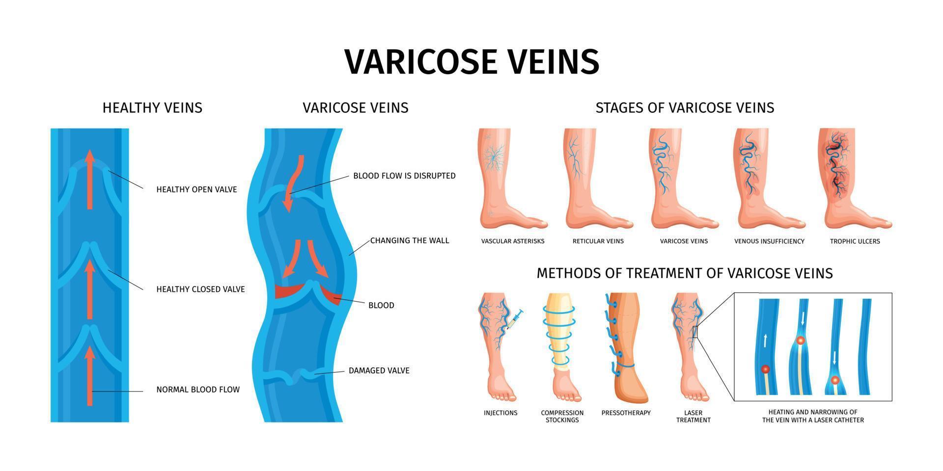 venas varicosas infografías realistas vector