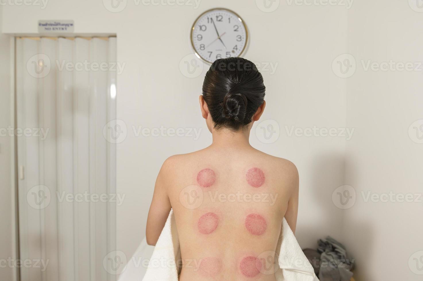 hermosa mujer recibió tratamiento de ventosas en la espalda por parte de un terapeuta, tratamiento de medicina china, concepto de salud y curación. foto