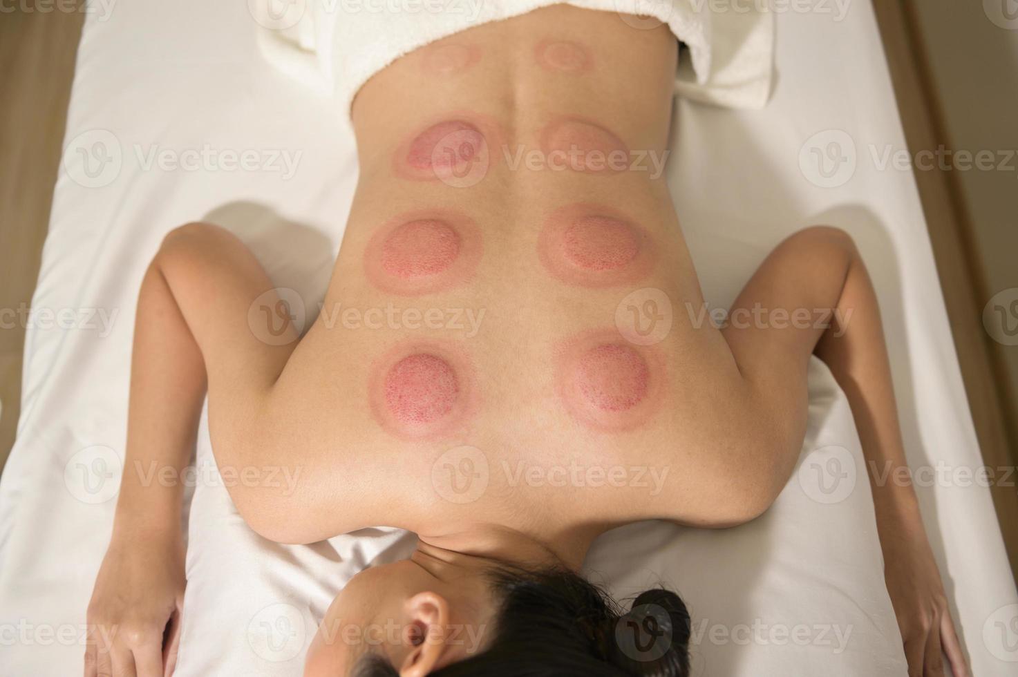 Beautiful Woman Received cupping treatment on back by  therapist, chinese medicine treatment, health and healing concept. photo