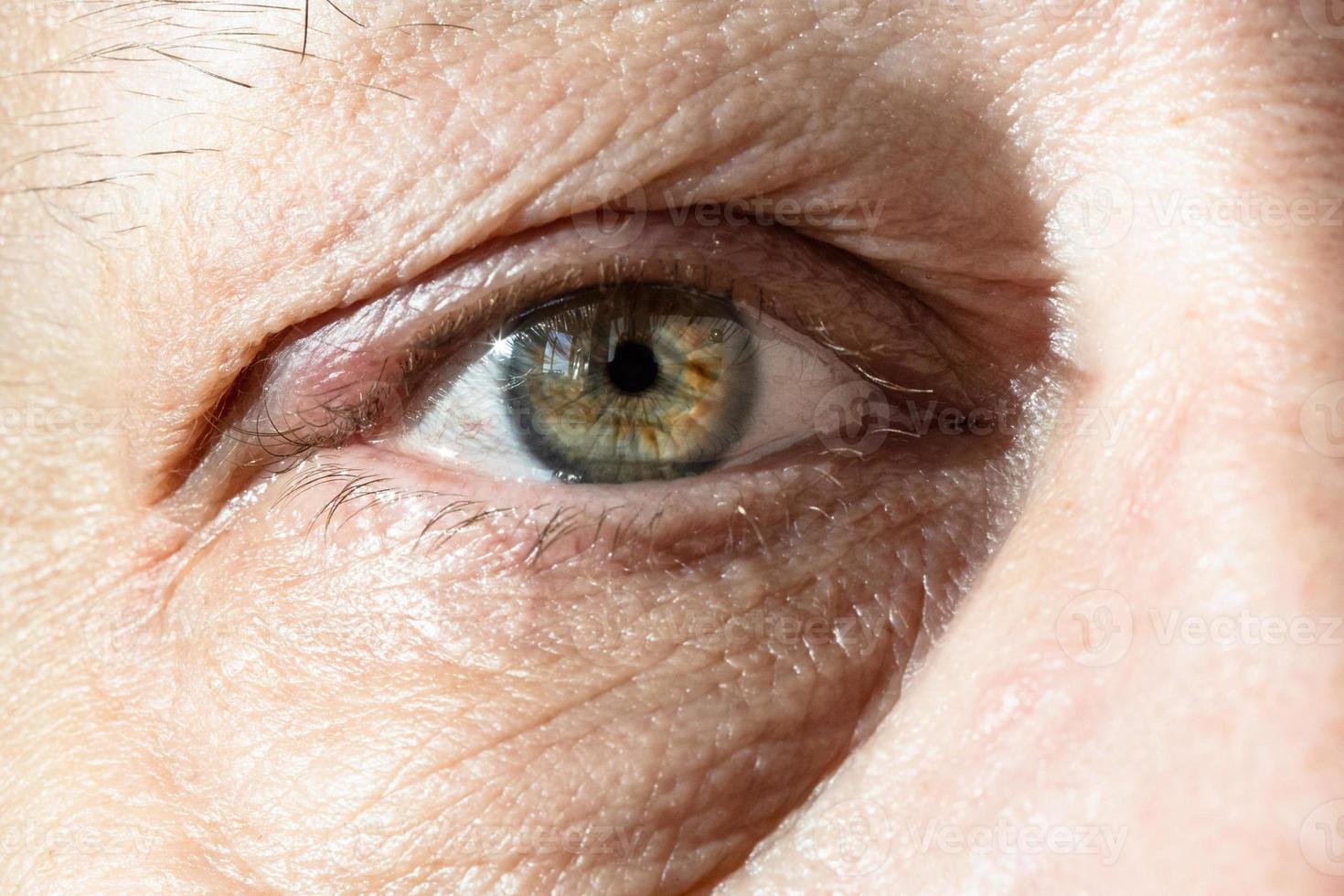 male eye with thickening on eyelid from chalazion photo