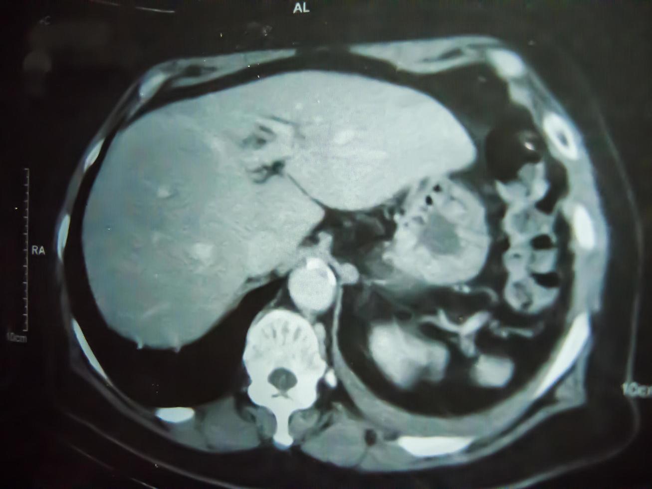 borrosa con el ruido de una tomografía computarizada de cáncer de pulmón en negro. foto