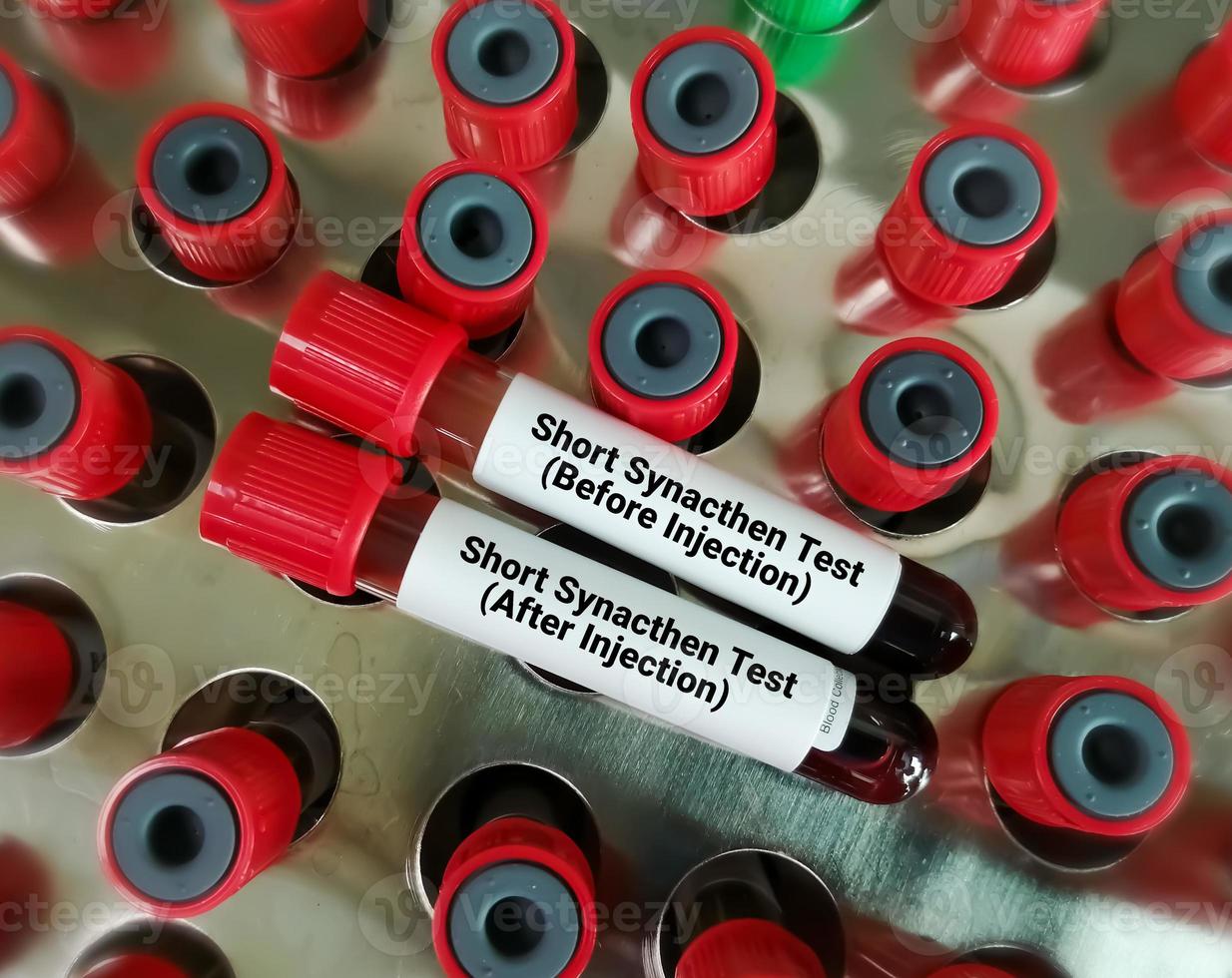 Bloods sample for short Synacthen test. Before injection and after injection. ACTH Stimulation test. photo