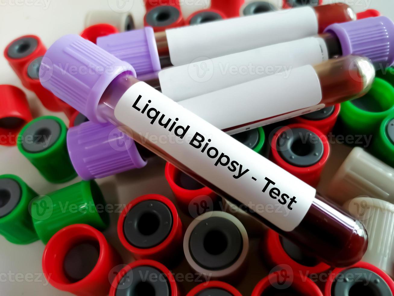 Blood samples for Liquid biopsy blood test to detect cancer cells or DNA fragments that circulate in the bloodstream, Lung cancer, laboratory background. photo