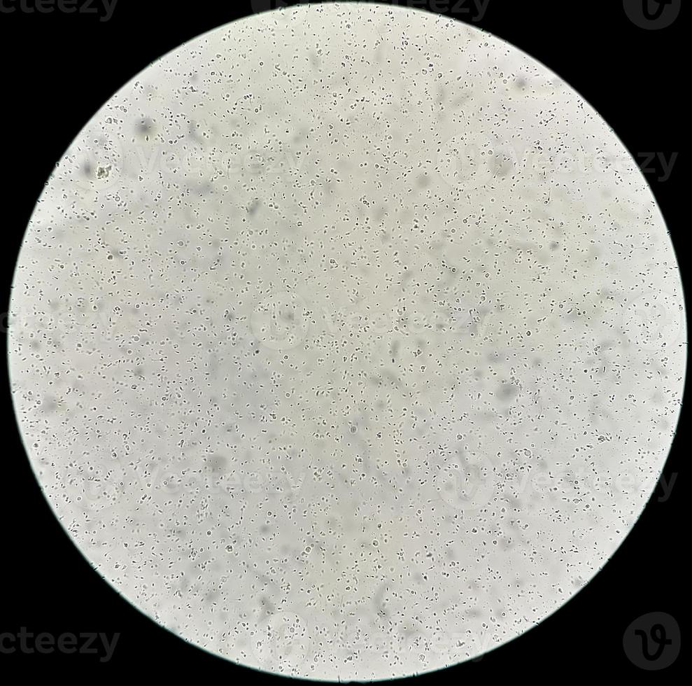Semen analysis under microscopy showing Pyospermia or leukocytospermia. Sperm analysis. photo