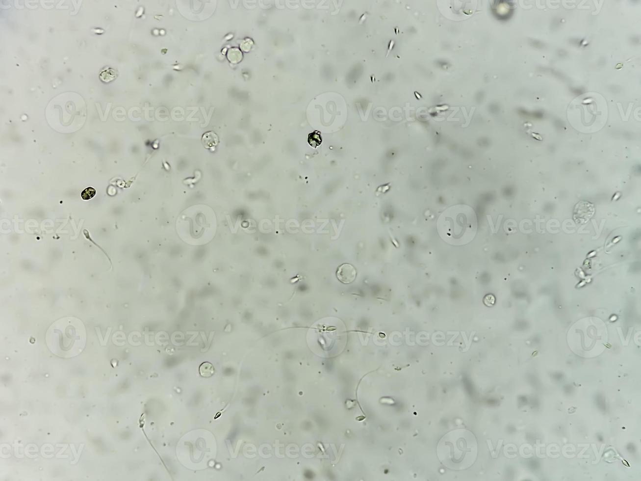 Semen analysis under microscopy showing Pyospermia or leukocytospermia. Sperm analysis. photo