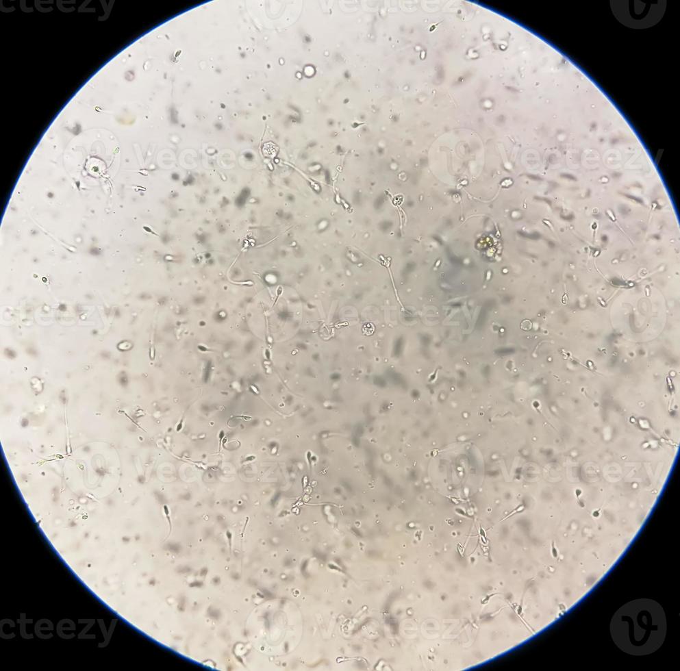 Semen analysis under microscopy showing Pyospermia or leukocytospermia. Sperm analysis. photo