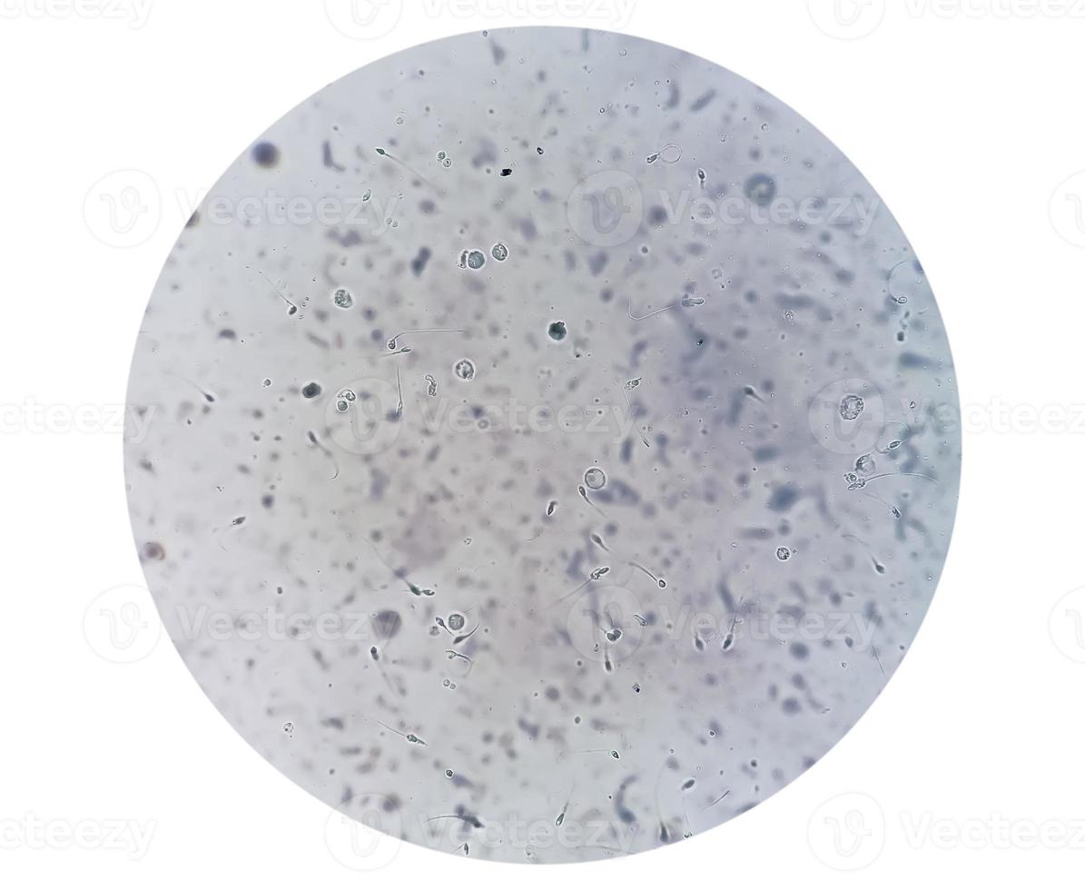 Semen analysis under microscopy showing Pyospermia or leukocytospermia. Sperm analysis. photo