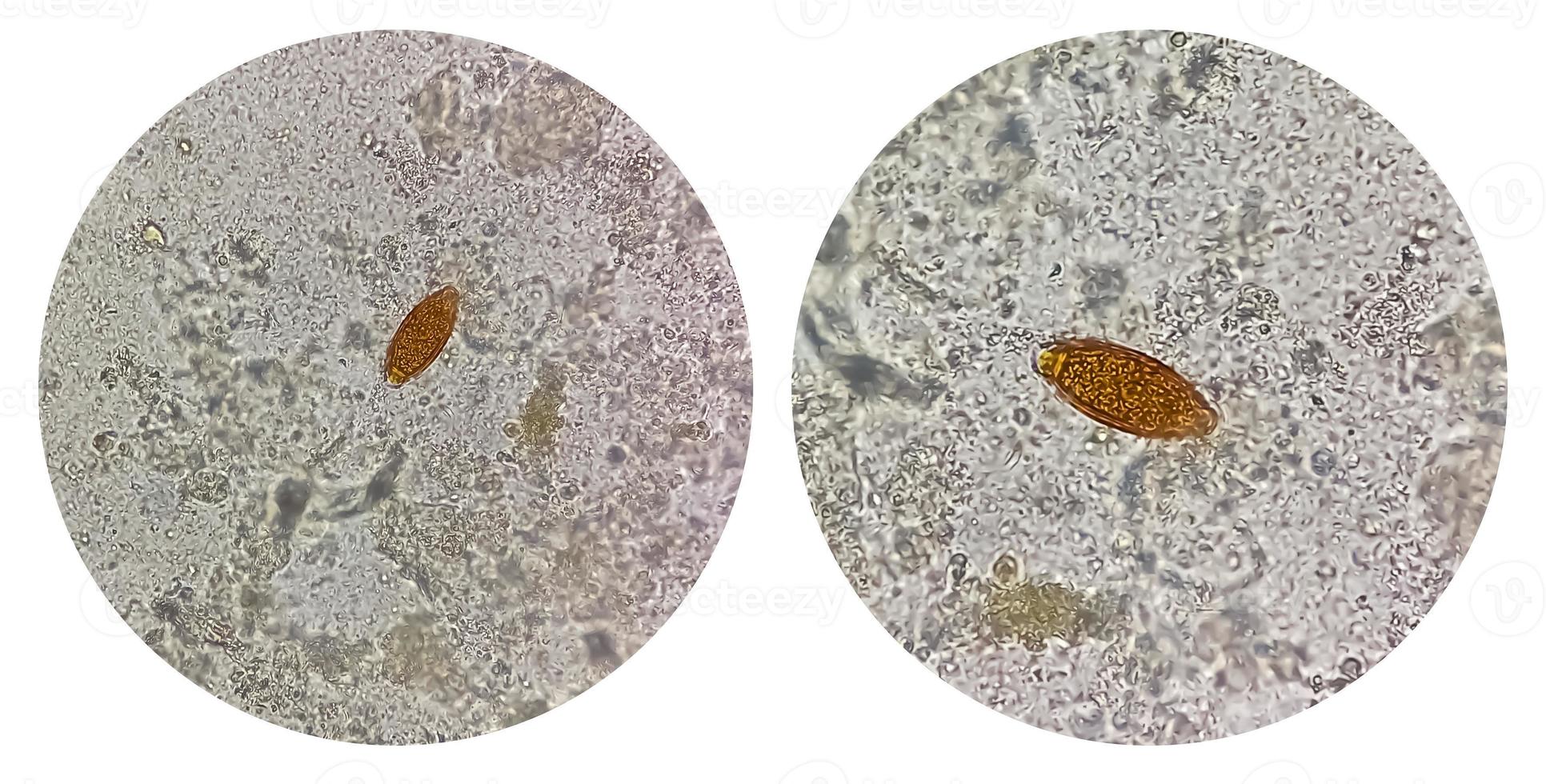 Photo collage of Trichuris trichiura ova whipworm in stool, analyze by microscope. Parasite egg.