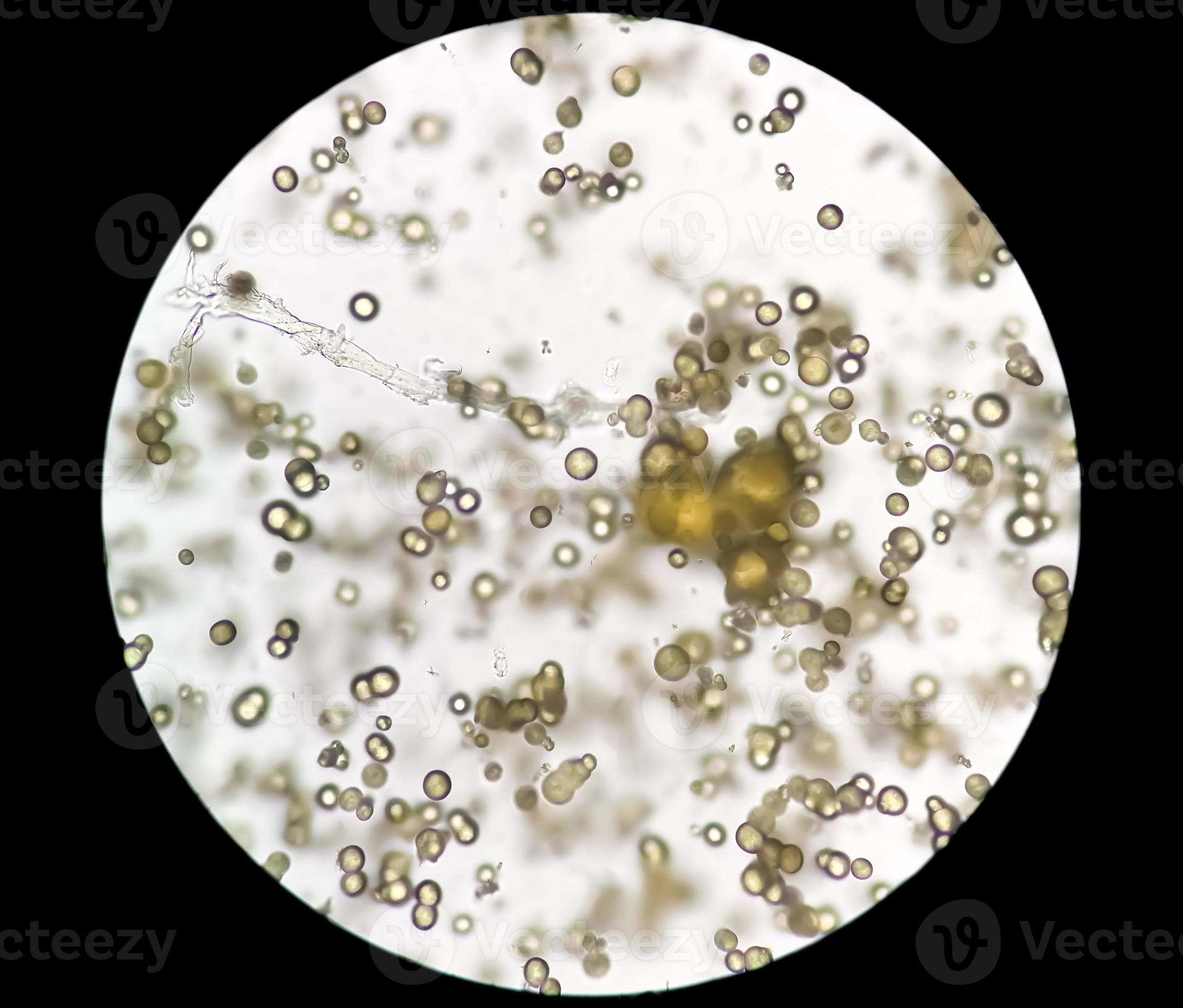 Microscopic image of Urinalysis. Abnormal urine exam. Uric acid