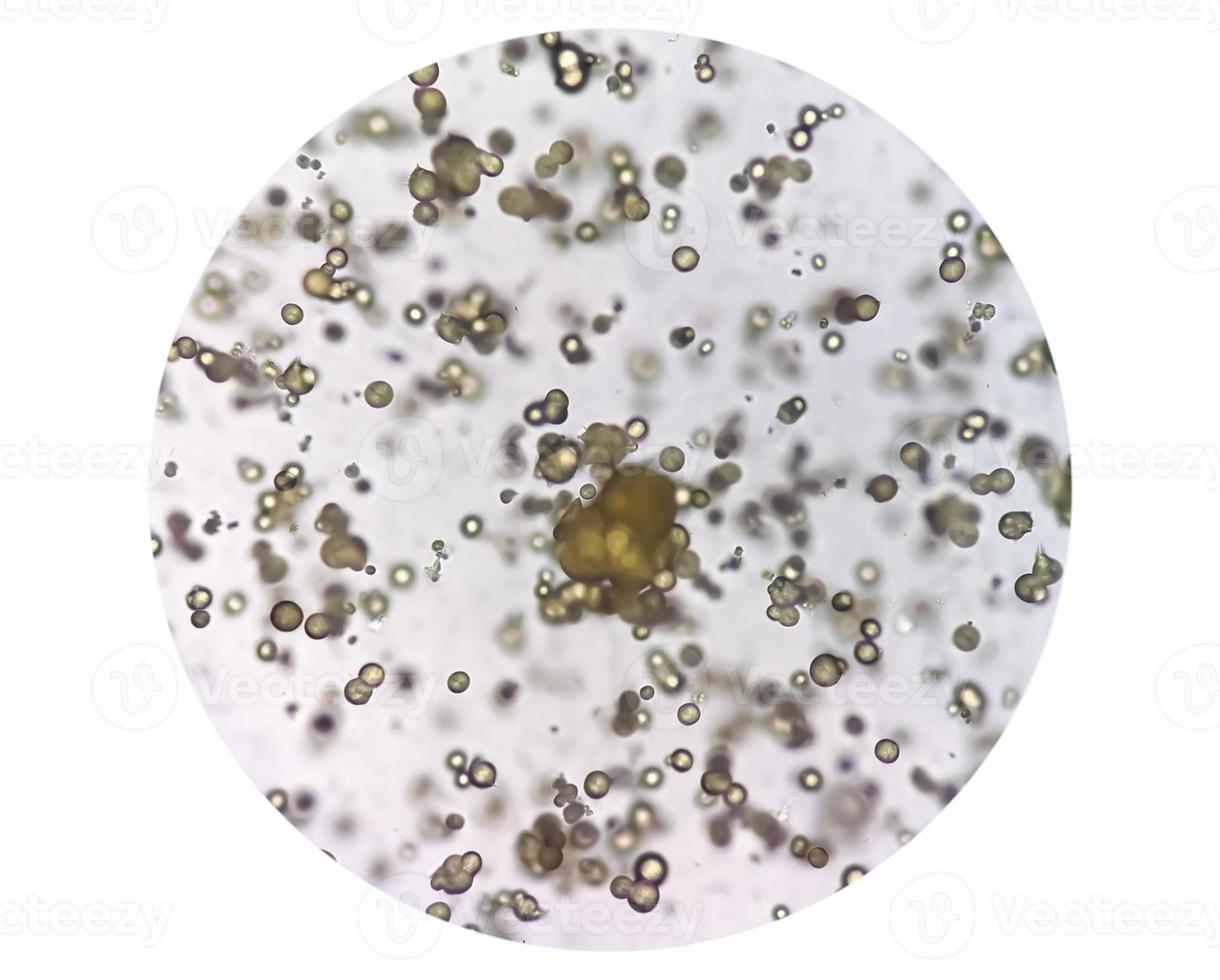 Microscopic image of Urinalysis. Abnormal urine exam. Uric acid crystals. photo