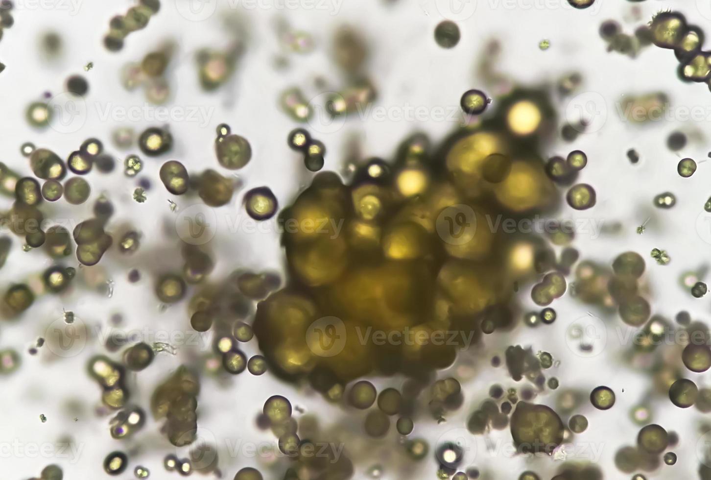 Microscopic Image Of Urinalysis Abnormal Urine Exam Uric Acid 