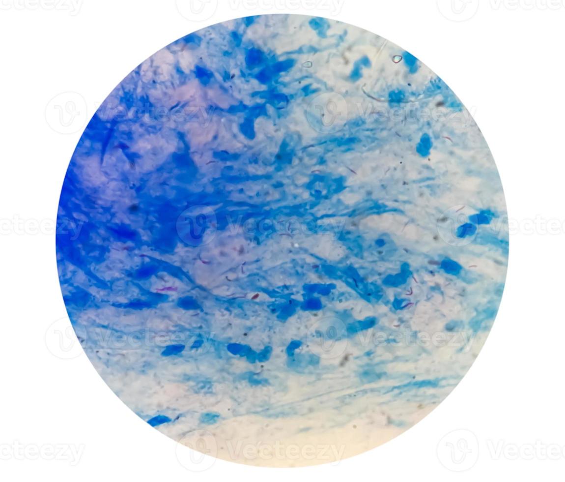 Sputum or phlegm smear AFB stain under microscopy showing Macrobacterium Tuberculosis Bacteria or MTB photo