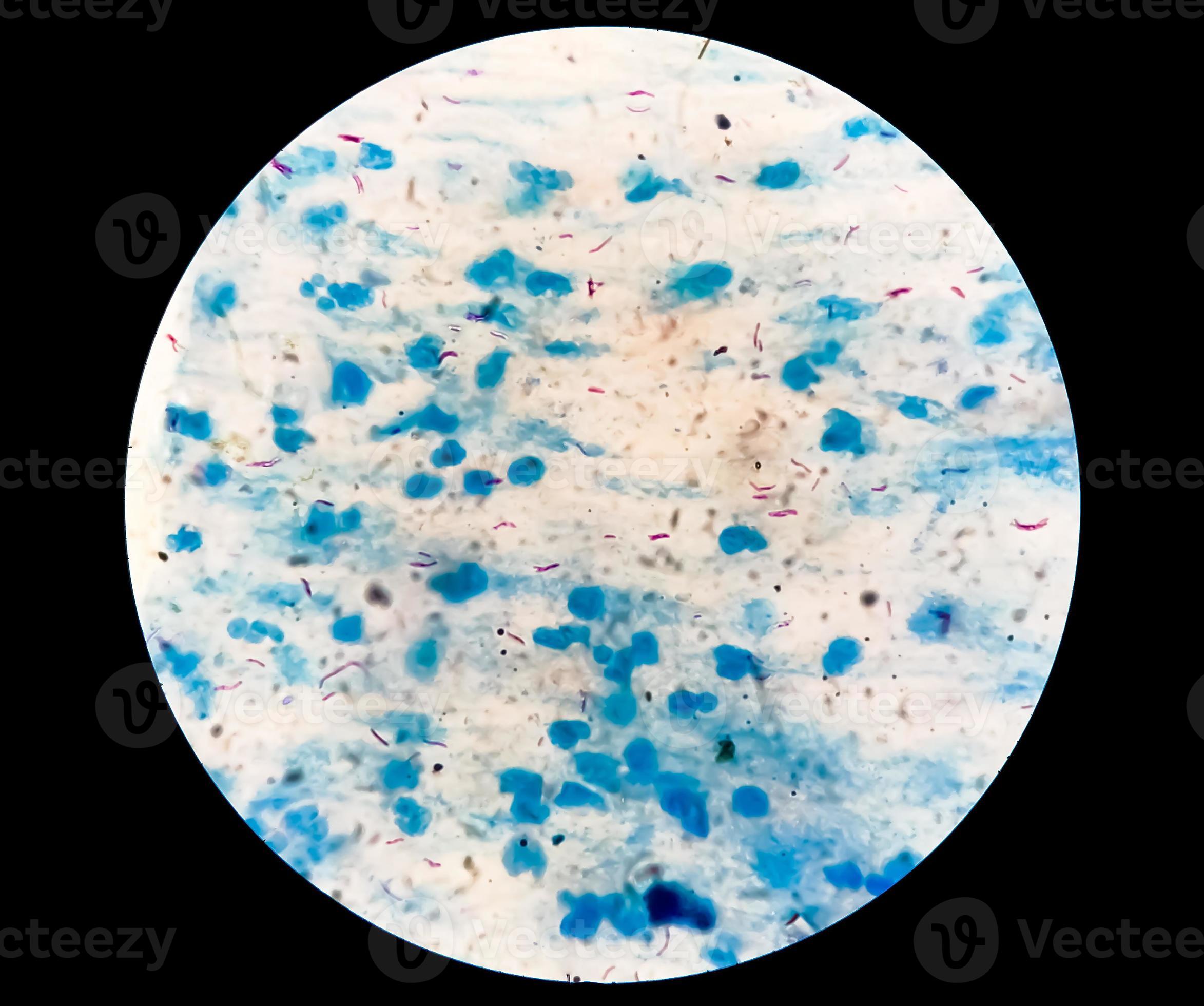 Sputum or phlegm smear AFB stain under microscopy showing