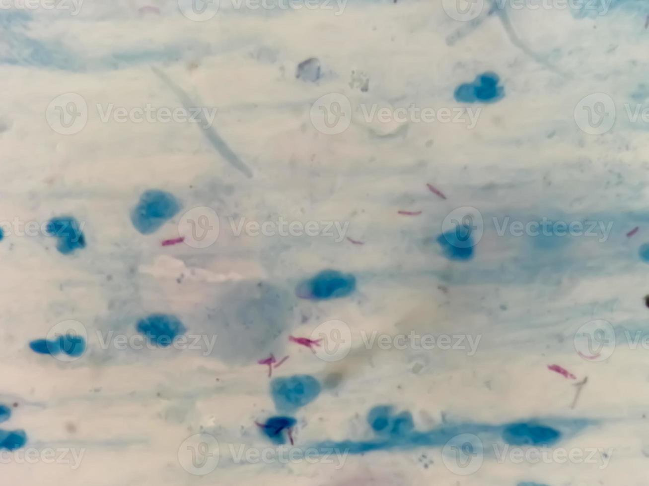 Sputum or phlegm smear AFB stain under microscopy showing Macrobacterium Tuberculosis Bacteria or MTB photo