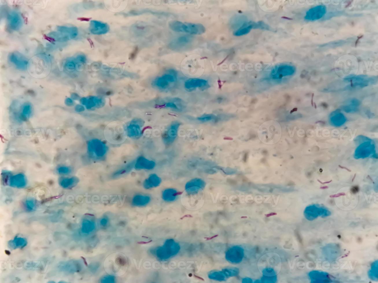 Sputum or phlegm smear AFB stain under microscopy showing Macrobacterium Tuberculosis Bacteria or MTB photo