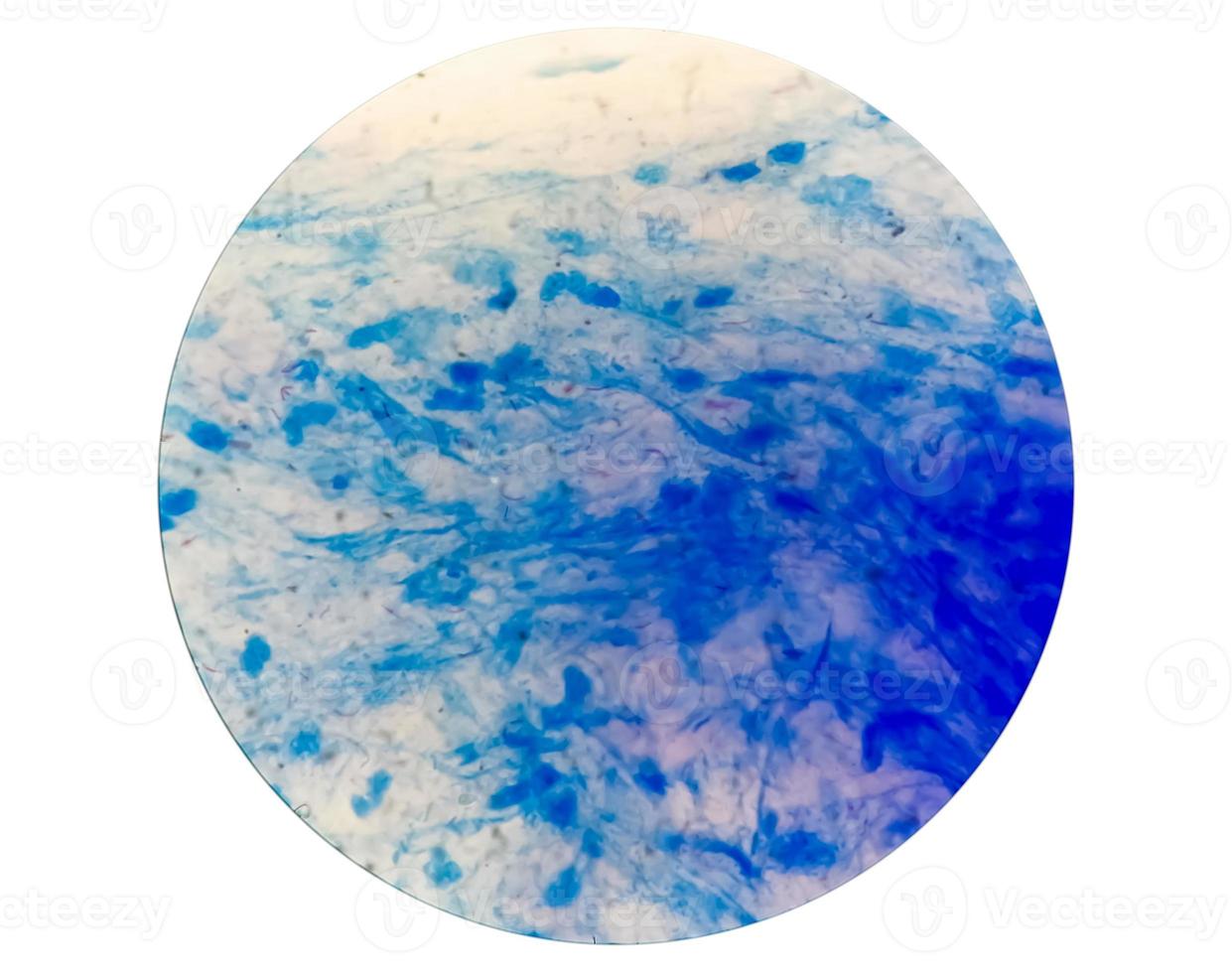 Sputum or phlegm smear AFB stain under microscopy showing Macrobacterium Tuberculosis Bacteria or MTB photo