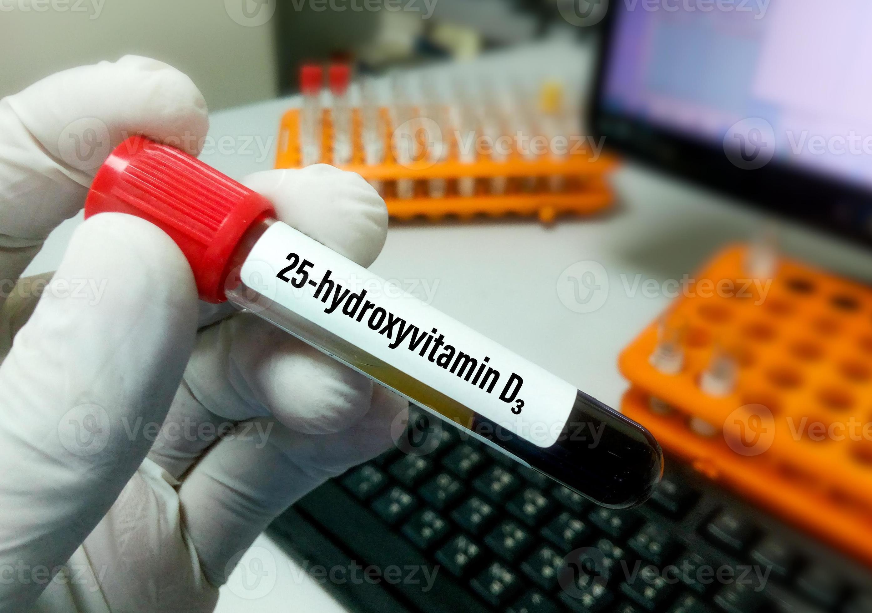 Muestra De Sangre Para La Prueba De 25 Hidroxivitamina D3 Tambi n muestra-de-sangre-para-la-prueba-de-25-hidroxivitamina-d3-tambi-n